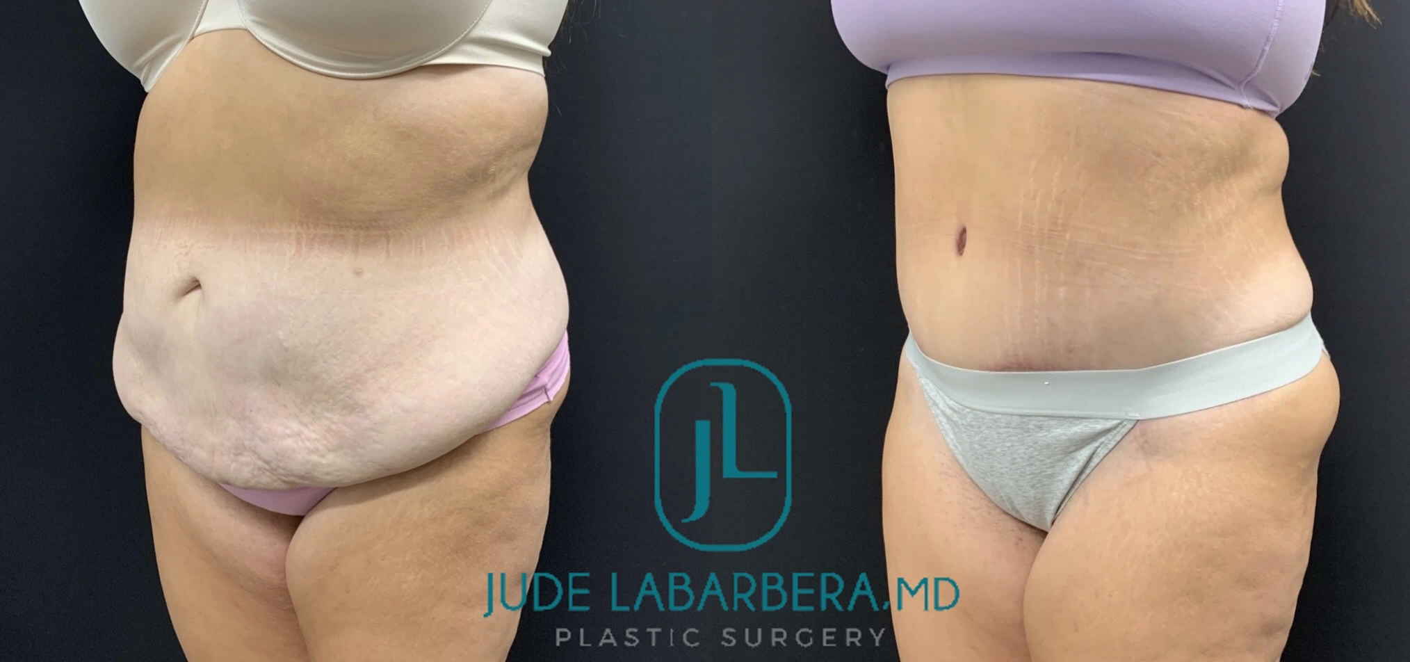 Before and after abdominal contouring results showing front view of torso