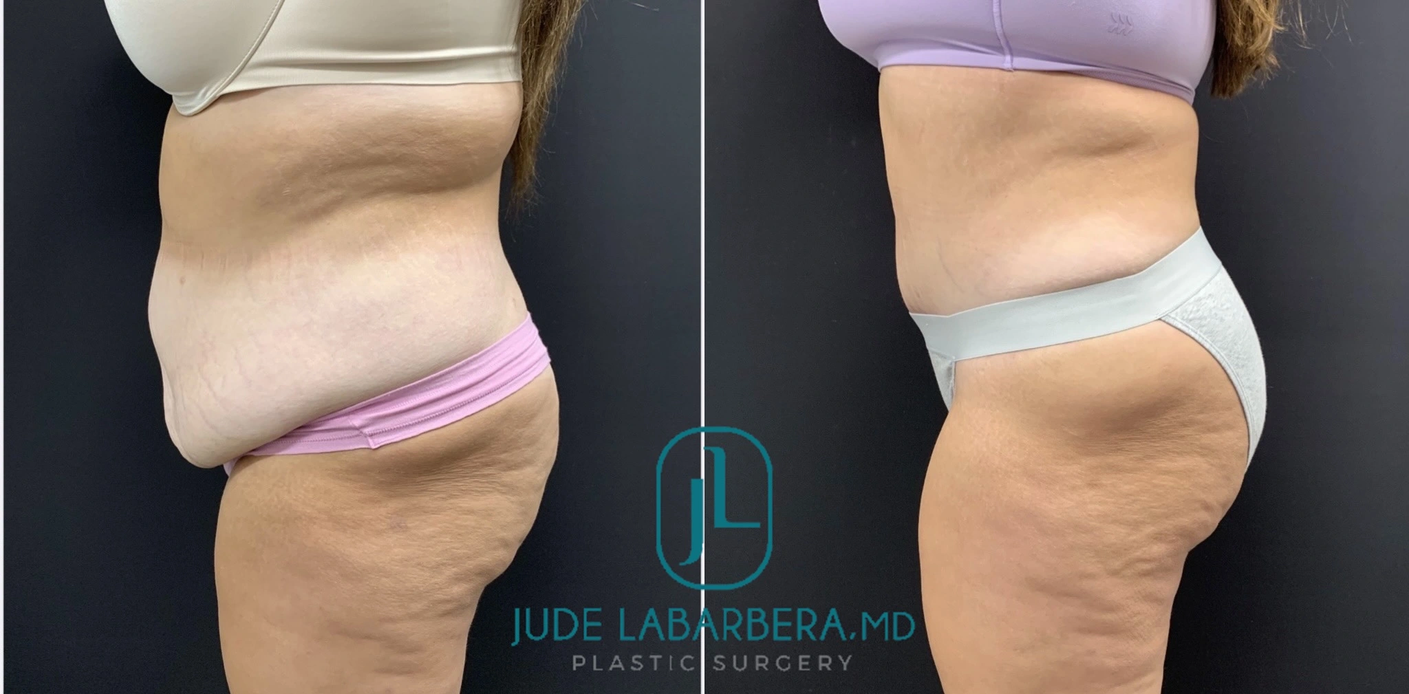 Before and after abdominal and lower body contouring results from side angle