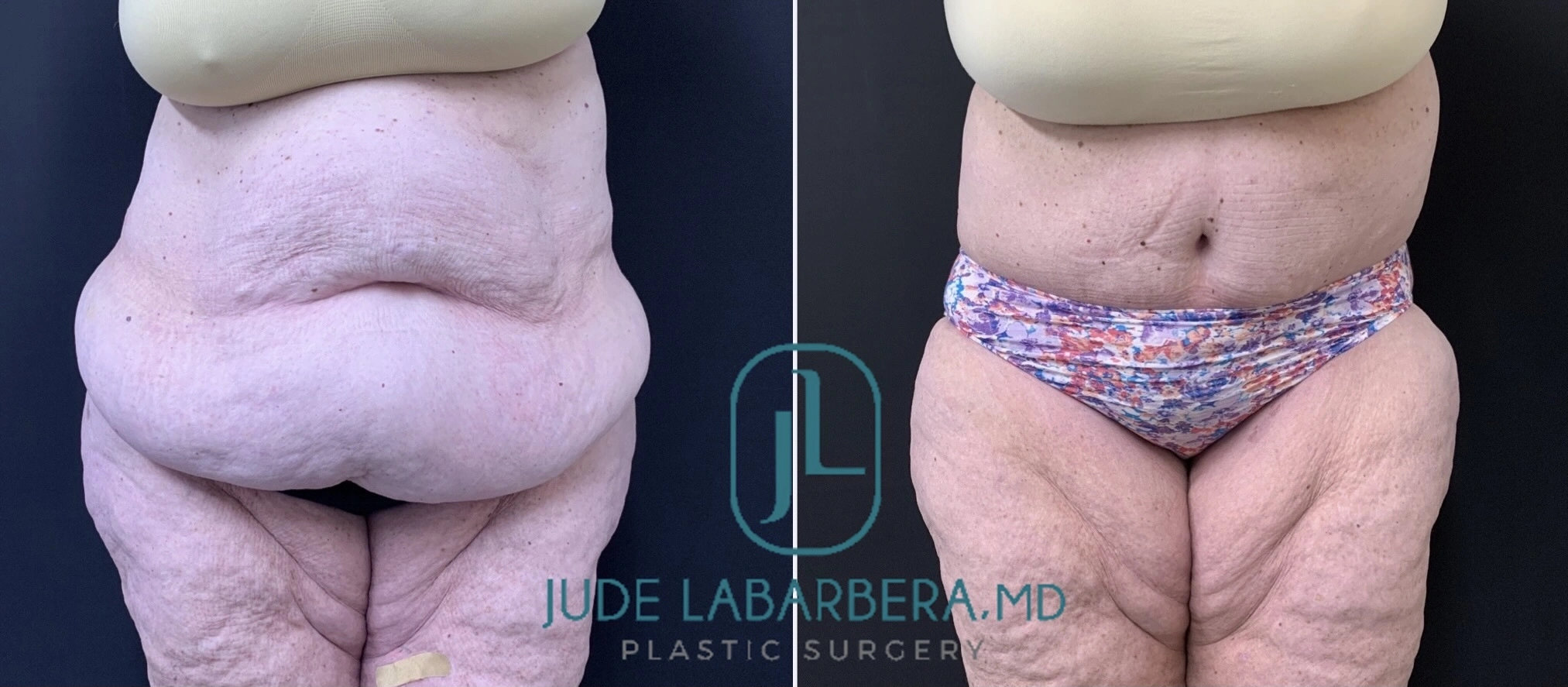 Before and after abdominoplasty results showing reduced abdominal fullness and improved contour