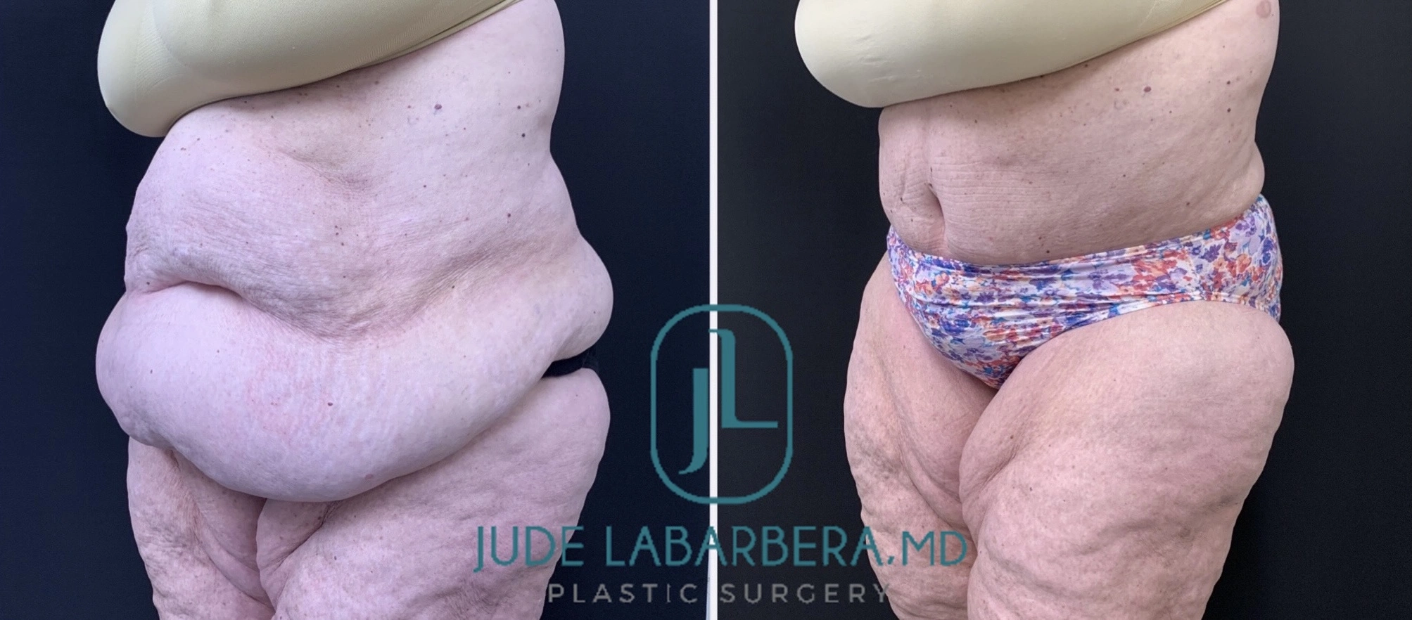 Before and after abdominoplasty from side view: left shows loose abdominal skin, right shows improved abdominal definition