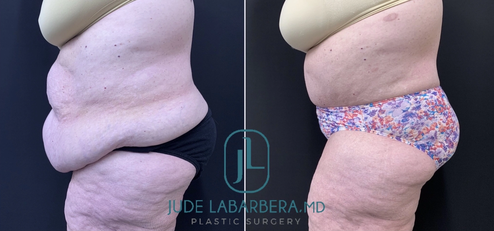 Before and after abdominoplasty from side view: left shows sagging lower abdomen, right shows lifted and tightened result