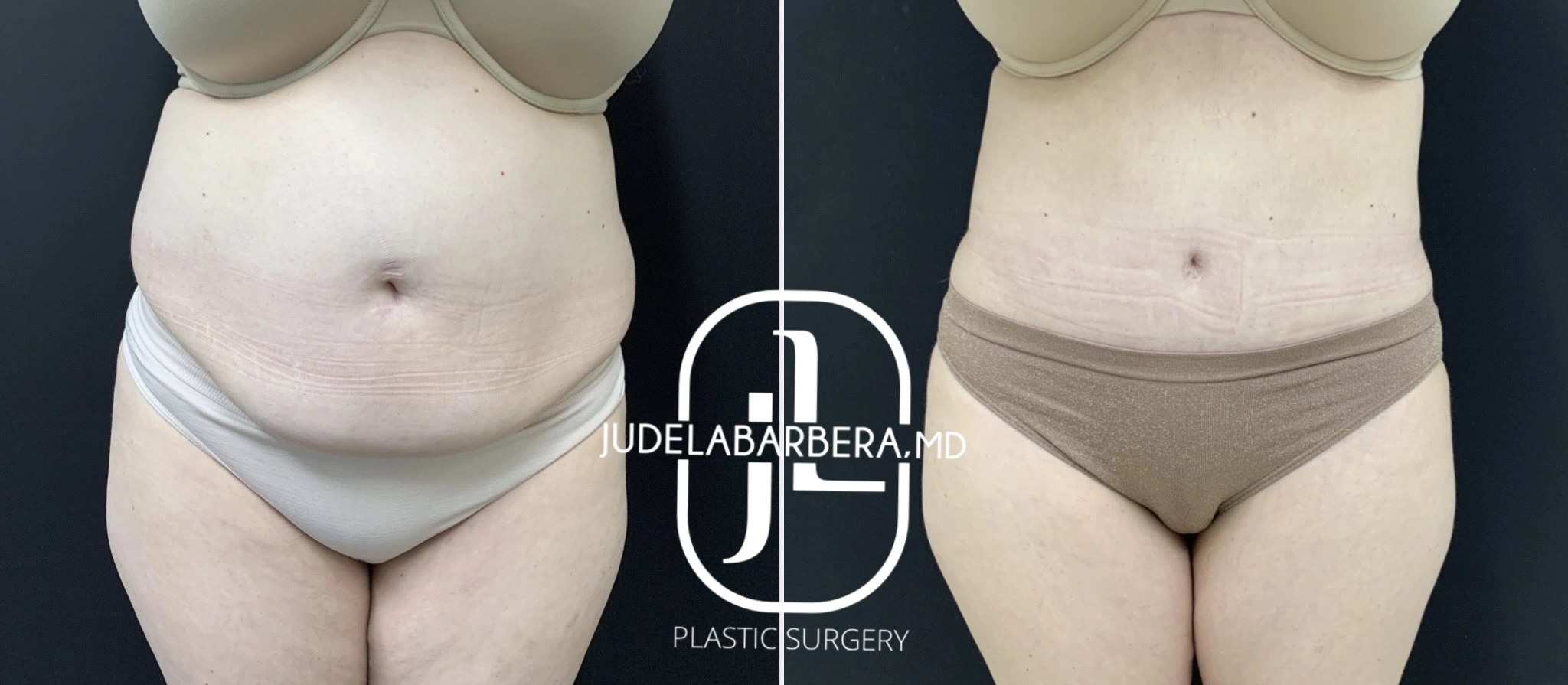 Before and after tummy tuck results showing flattened abdomen and improved contour