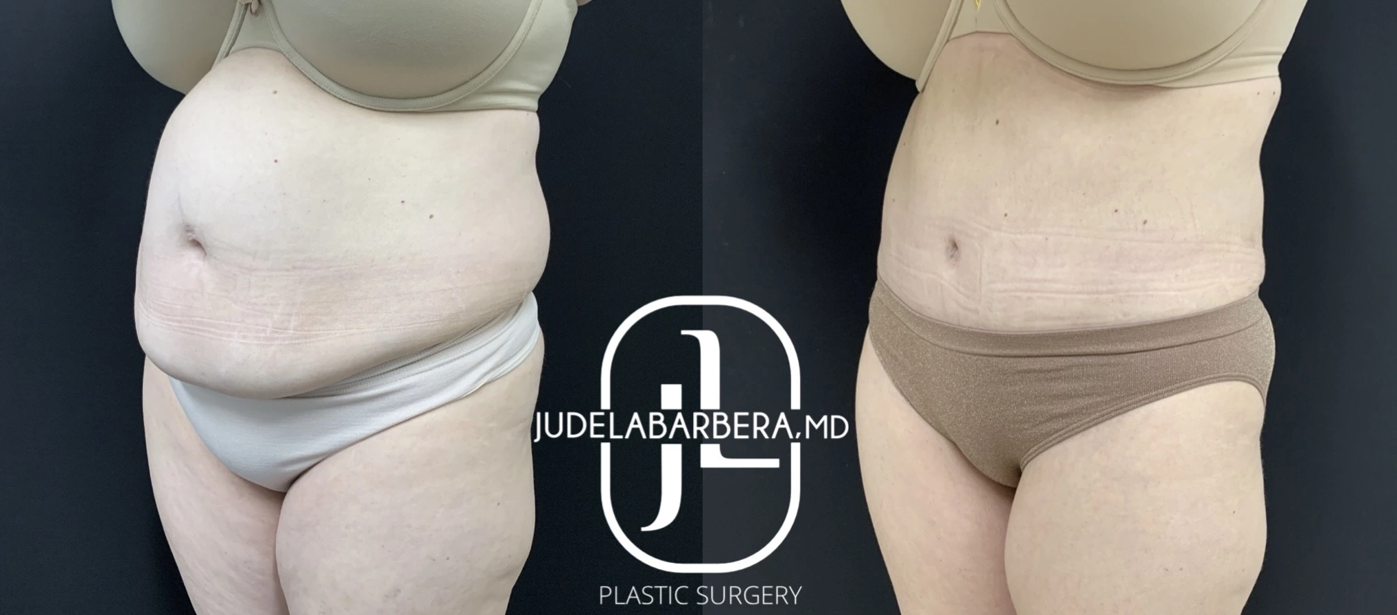 Before and after liposuction results showing reduced abdominal and flank fullness