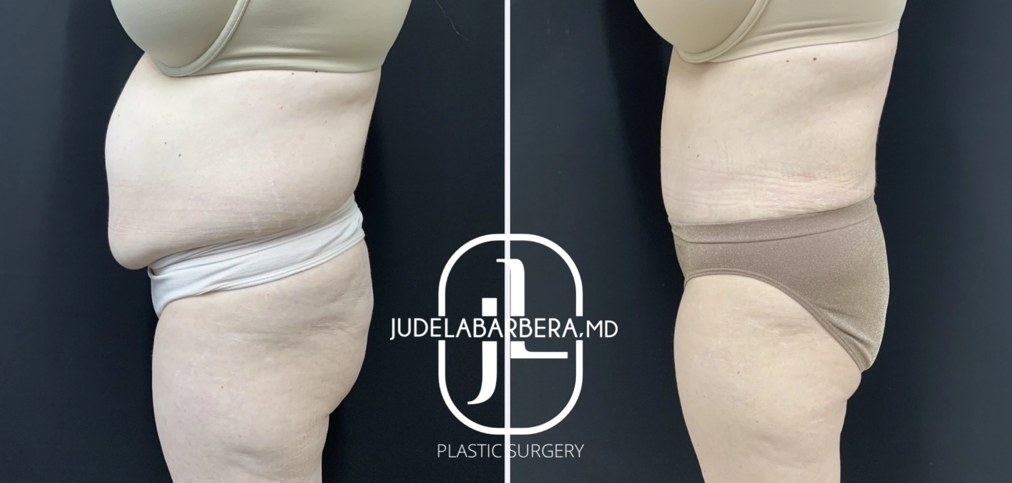Before and after liposuction results showing reduced thigh and hip contour