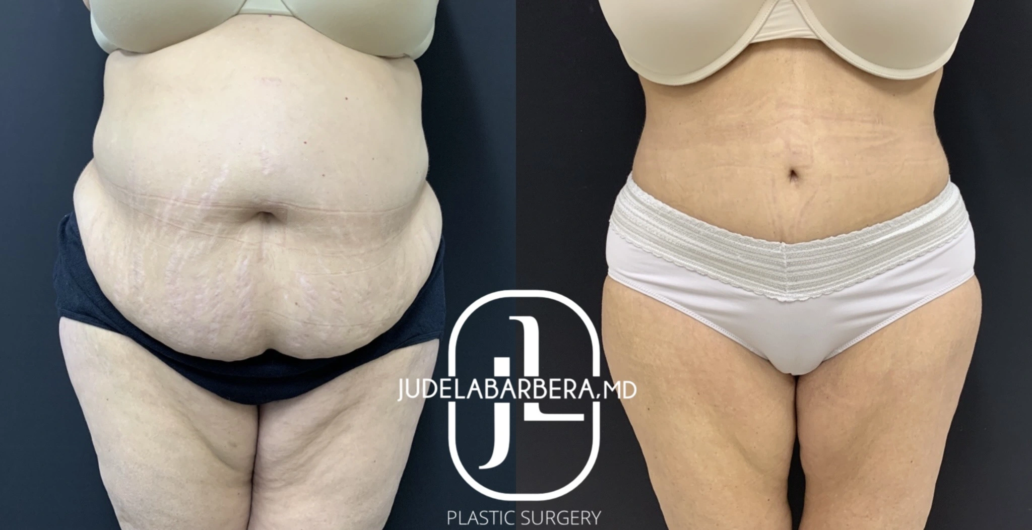 Before and after abdominoplasty showing front view of reduced abdominal fullness and improved contour