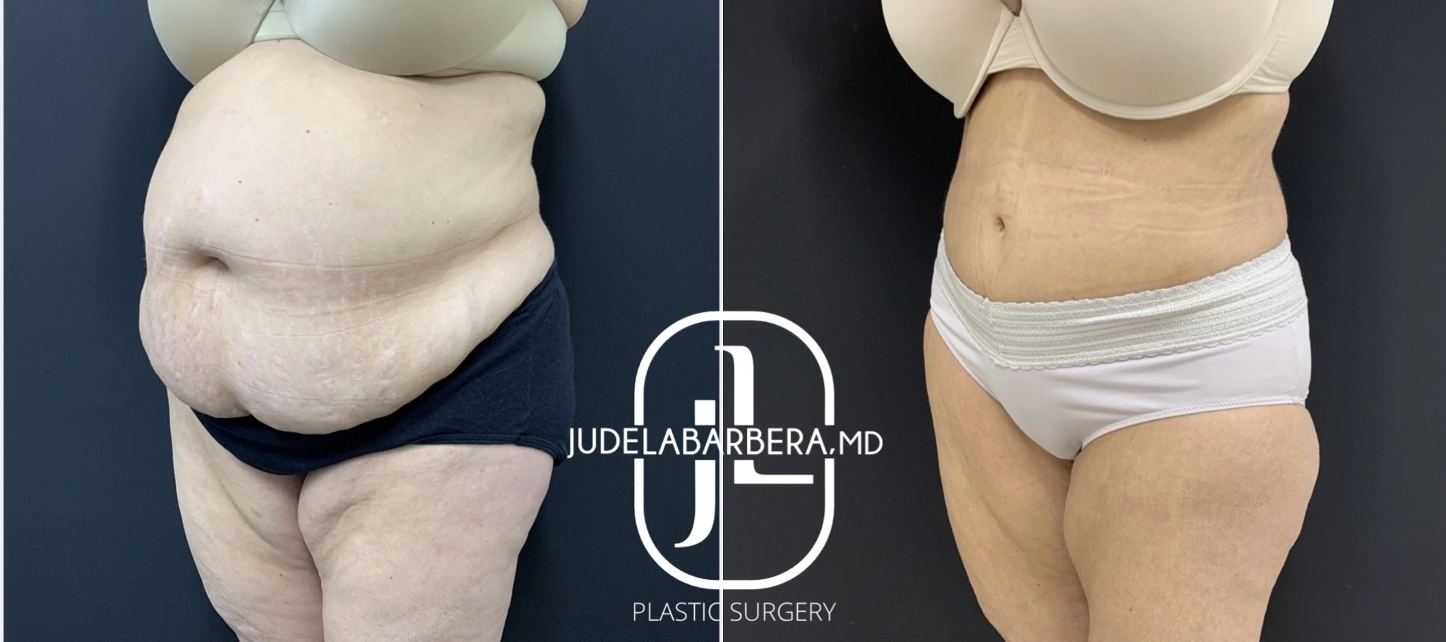 Before and after abdominoplasty showing side view of flattened abdomen and waistline definition