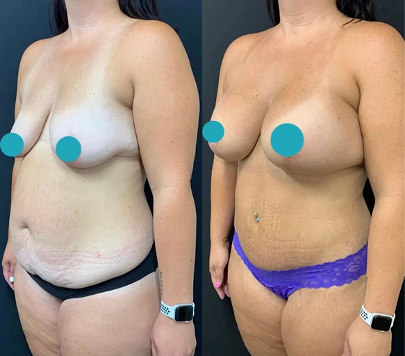 Mommy Makeover