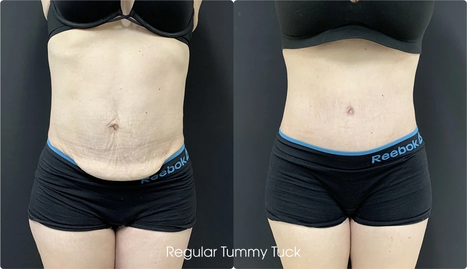 Regular Tummy Tuck Gallery: Before and After