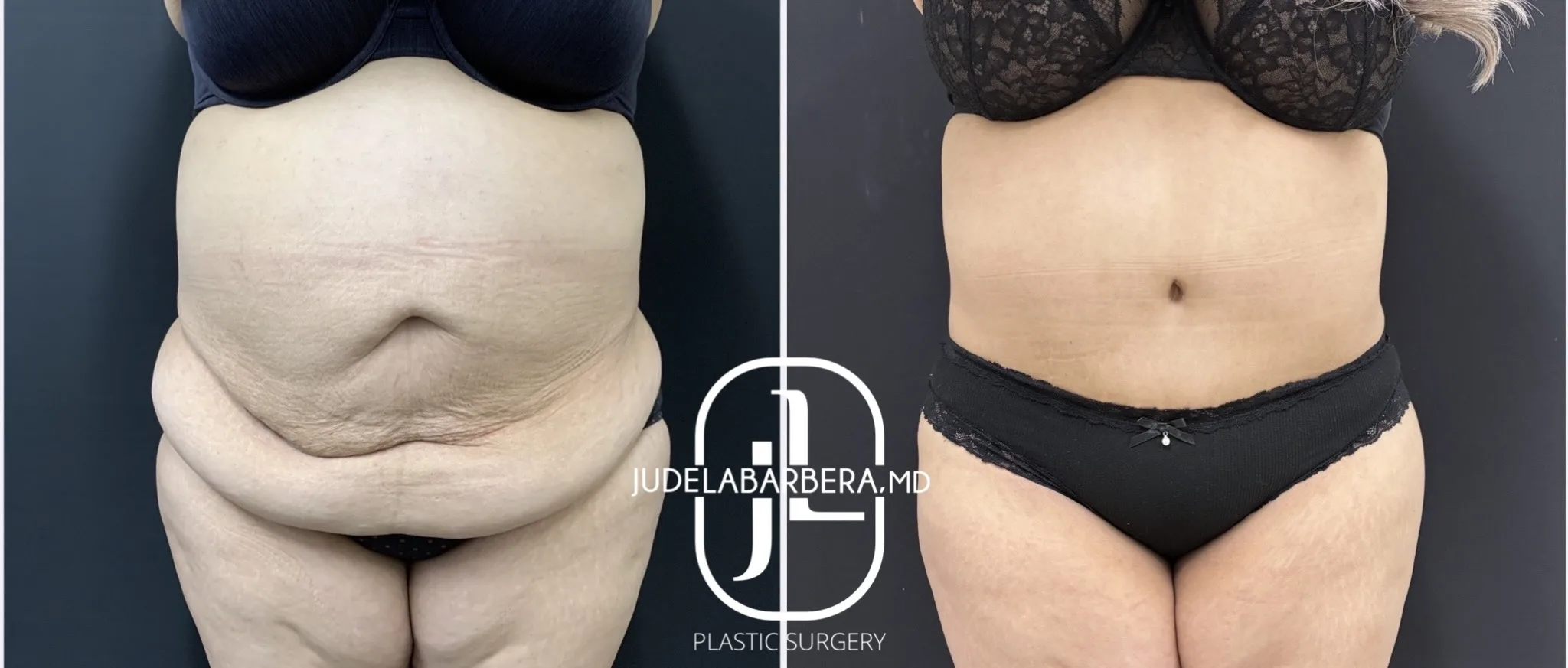 Before and after front view of abdomen and lower torso showing body contouring results