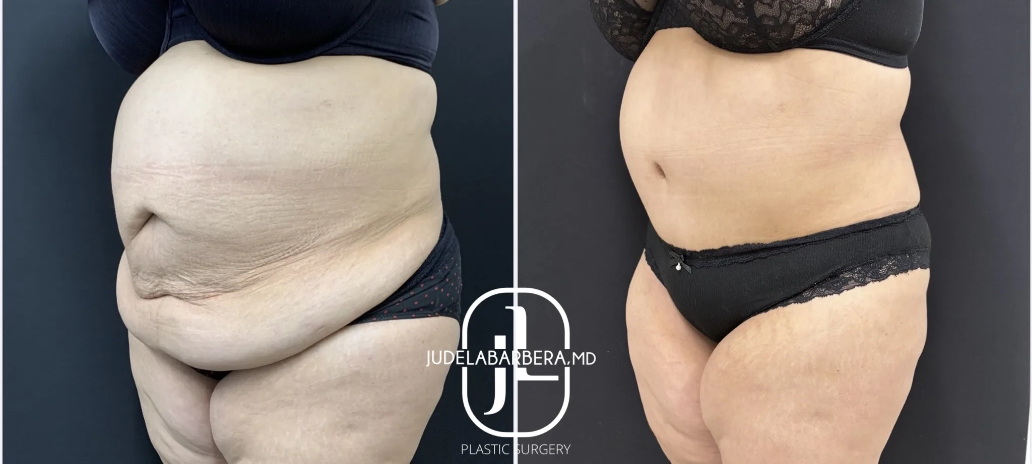 Before and after front view of abdomen and torso showing liposuction and body contouring results