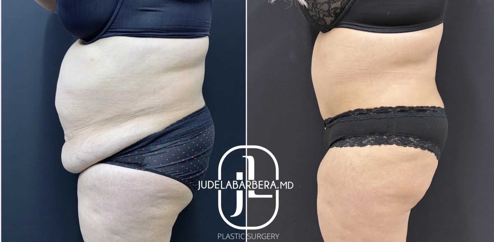 Before and after side profile of abdomen showing liposuction and body contouring results