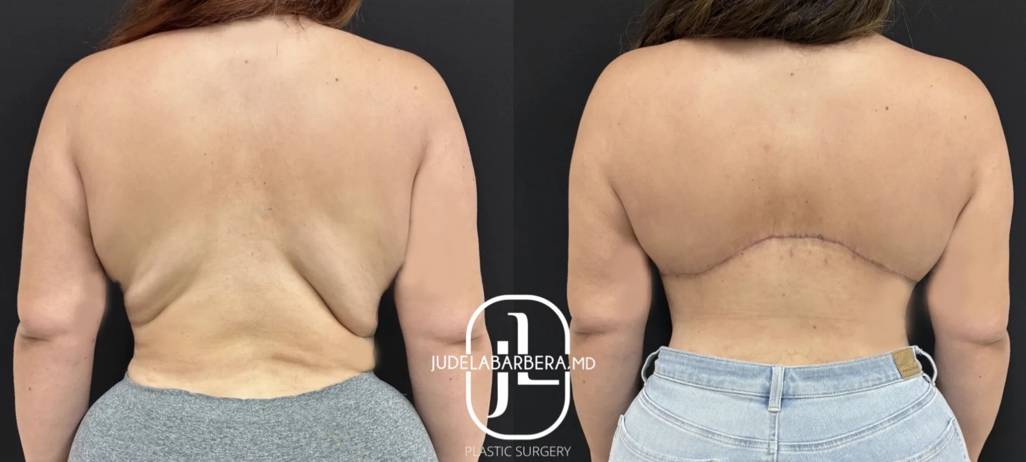 Before and after rear view of back and torso showing body contouring results