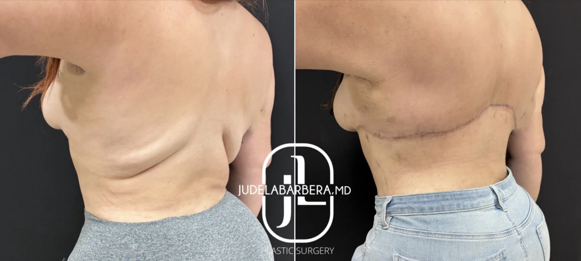 Before and after side profile comparison of torso showing results of body contouring surgery
