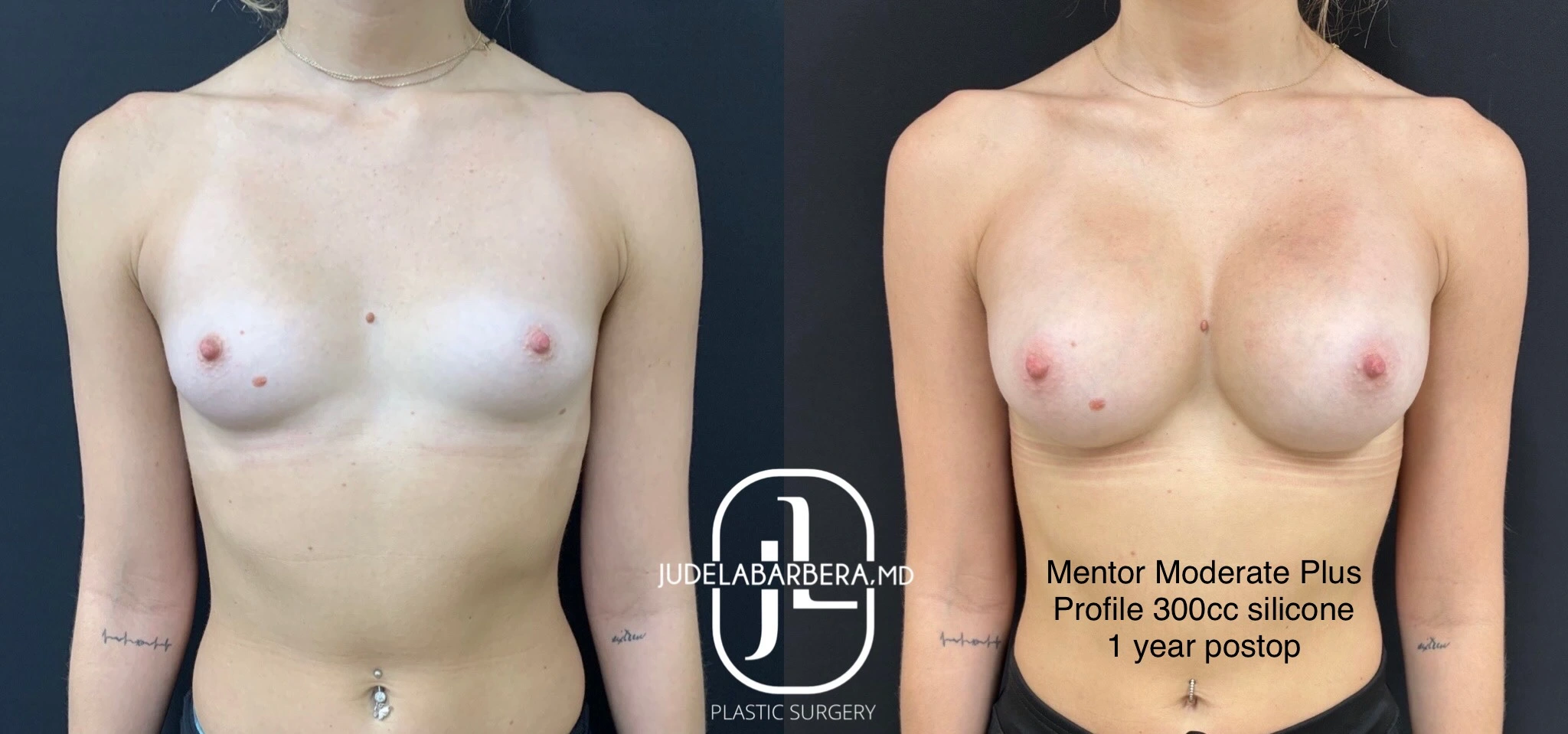Before and After Gallery: Breast Augmentation Banner