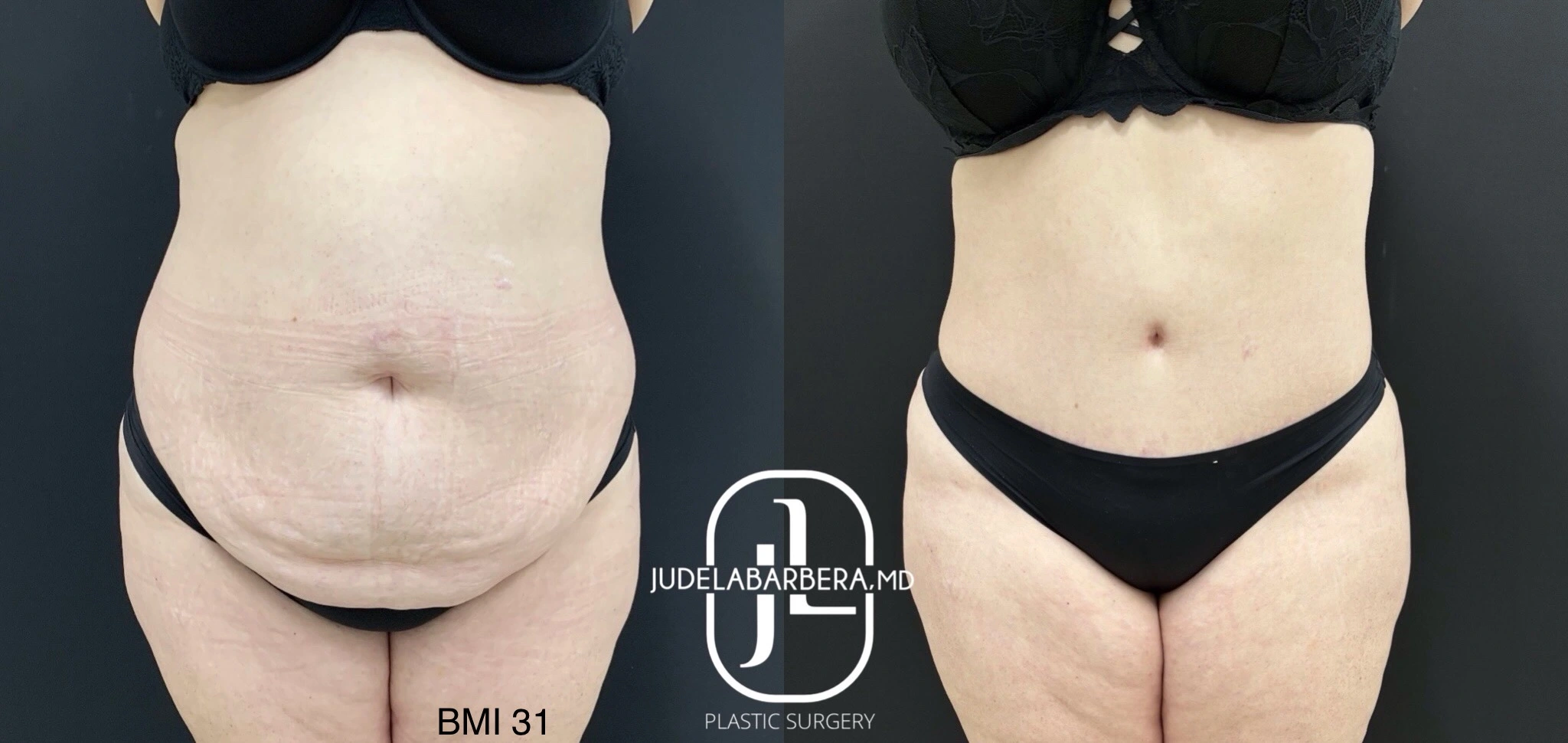 Before and after abdominoplasty with BMI 31 showing flattened abdomen and refined waistline