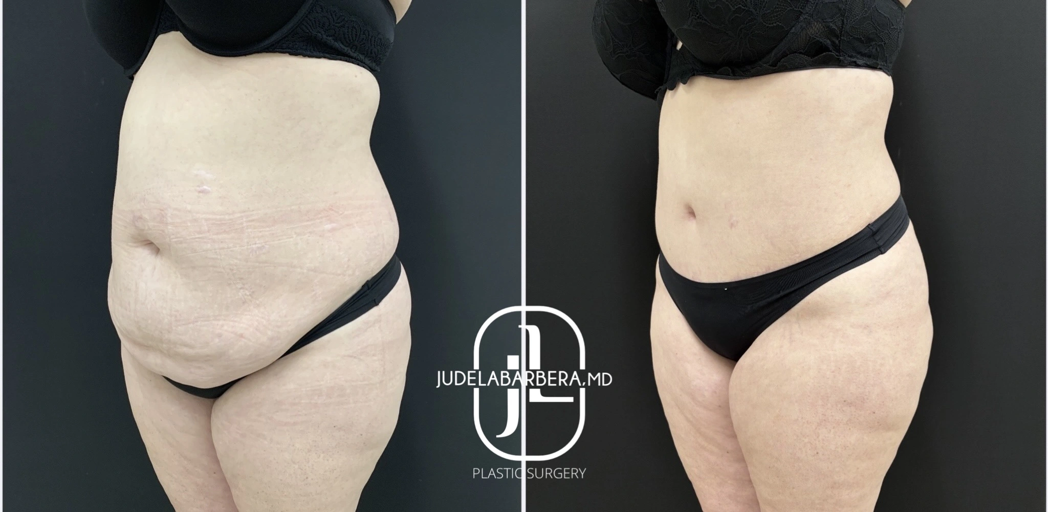 Before and after abdominal contouring: left shows excess abdominal skin and tissue, right shows flattened abdomen