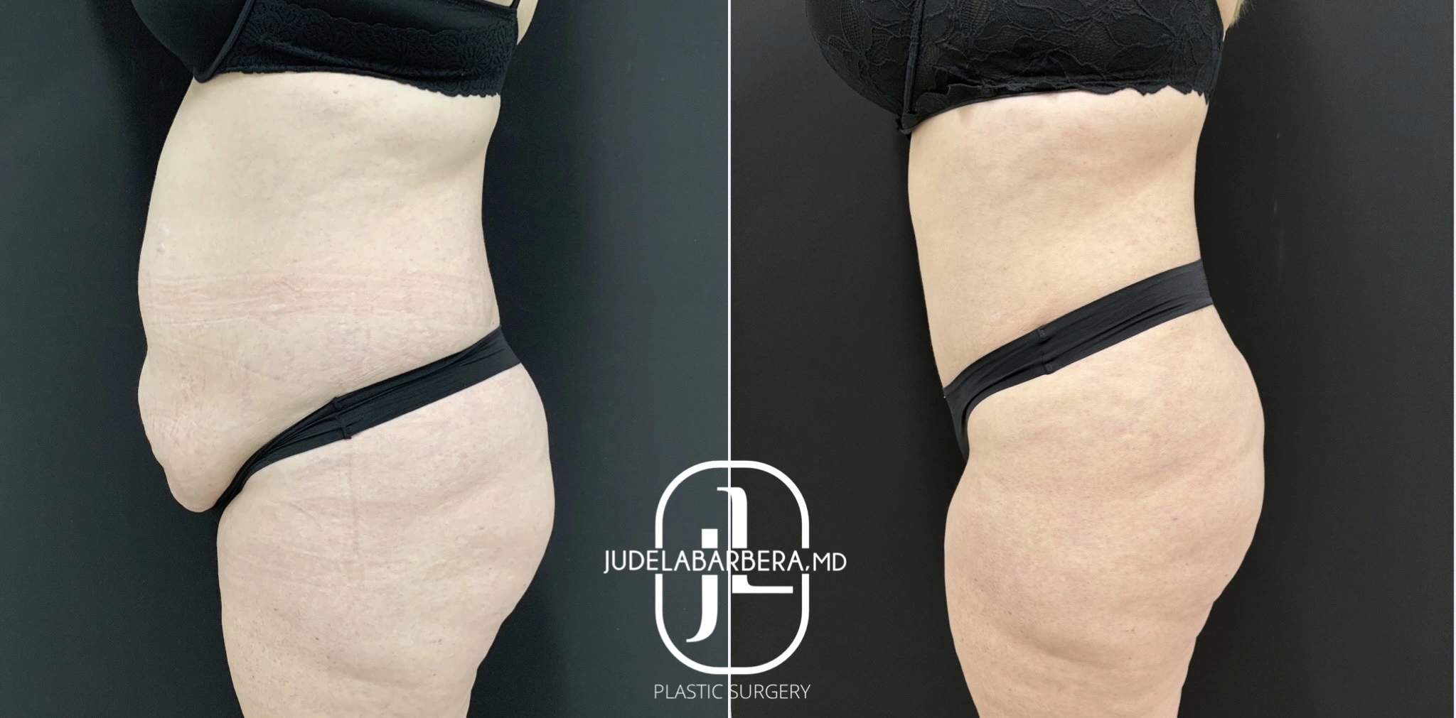 Before and after abdominal contouring from side angle: left shows protruding abdomen, right shows contoured midsection