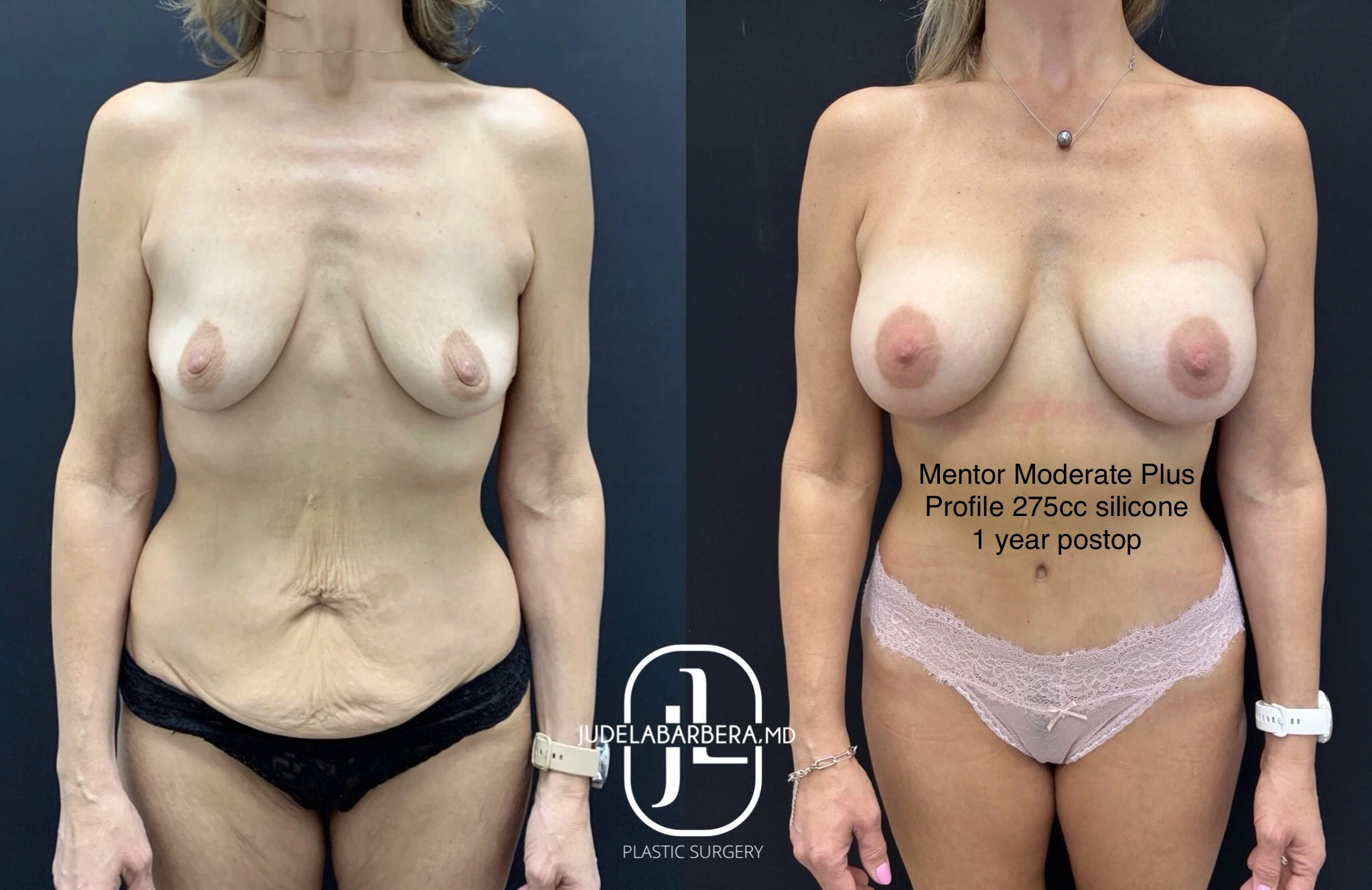 Before and after frontal view of breast augmentation with Mentor Moderate Plus Profile 275cc silicone implants, 1 year postop