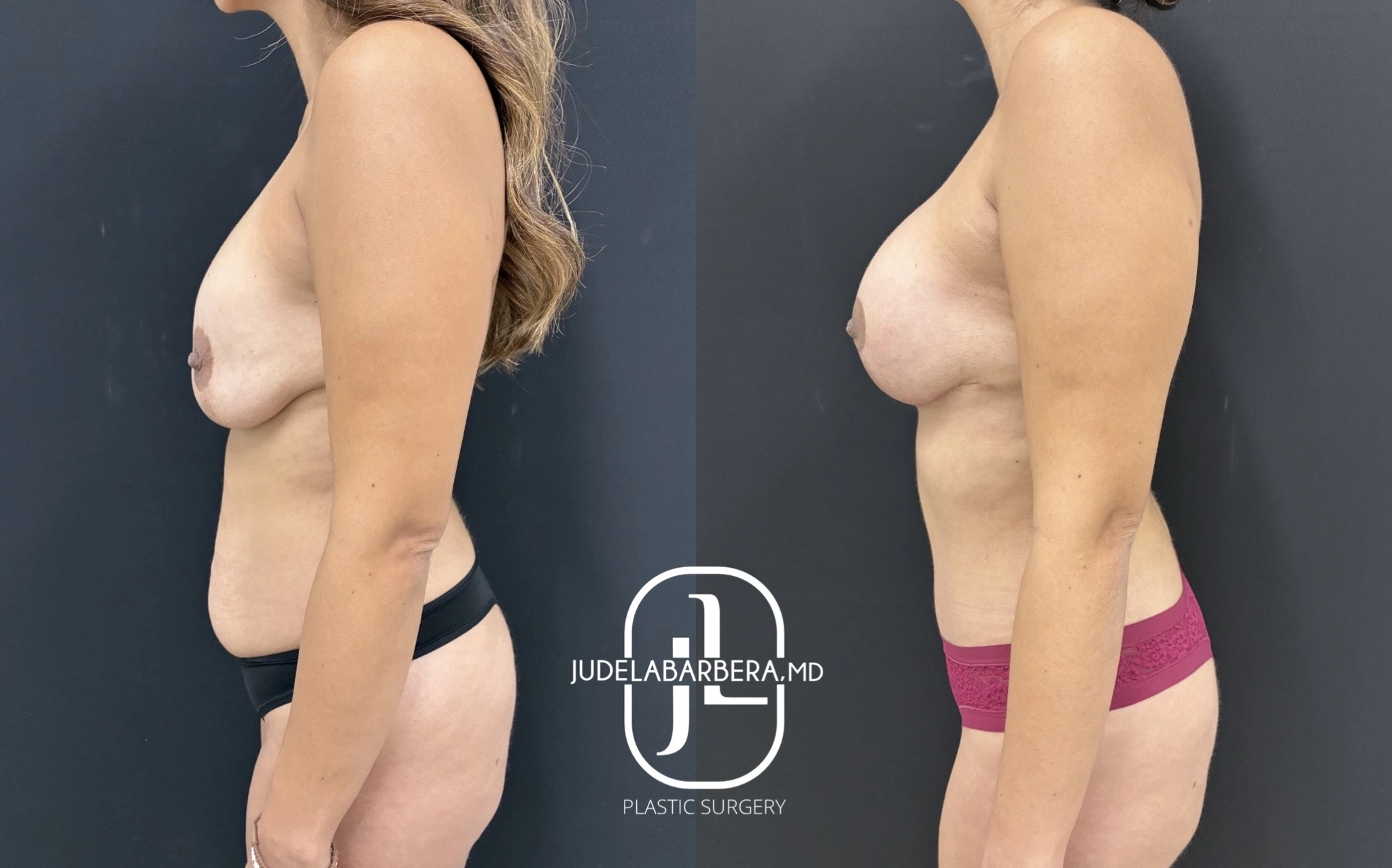 Side profile before and after breast augmentation demonstrating enhanced upper pole fullness and projection