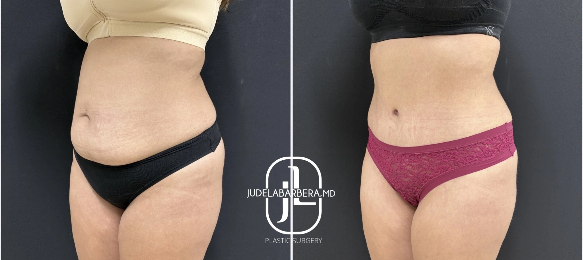 Before and after abdominal contouring showing front view with reduced midsection fullness