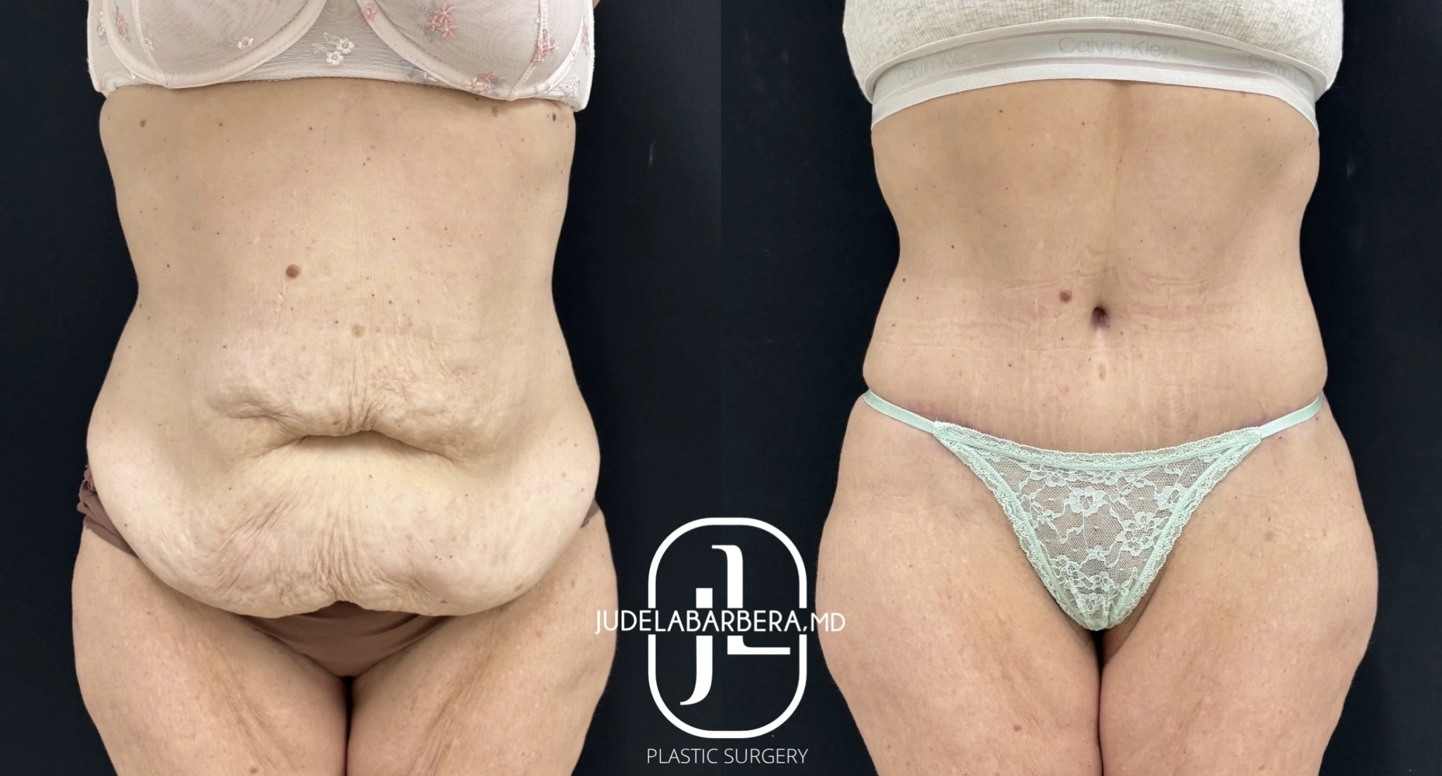 Before and after tummy tuck: left shows excess abdominal skin and laxity, right shows tightened abdomen and defined waistline
