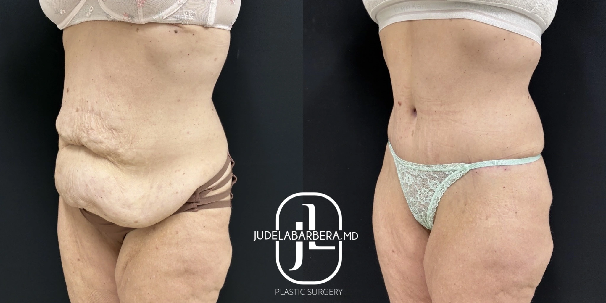 Before and after tummy tuck from side view: left shows sagging abdomen, right shows lifted and contoured midsection