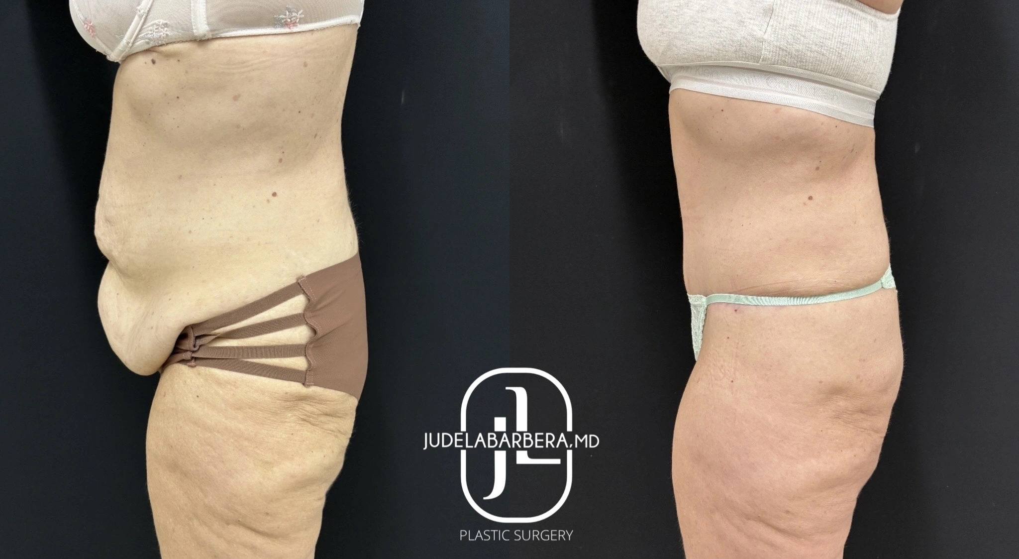Before and after tummy tuck and thighplasty: left shows excess abdominal and thigh skin, right shows contoured abdomen and thighs