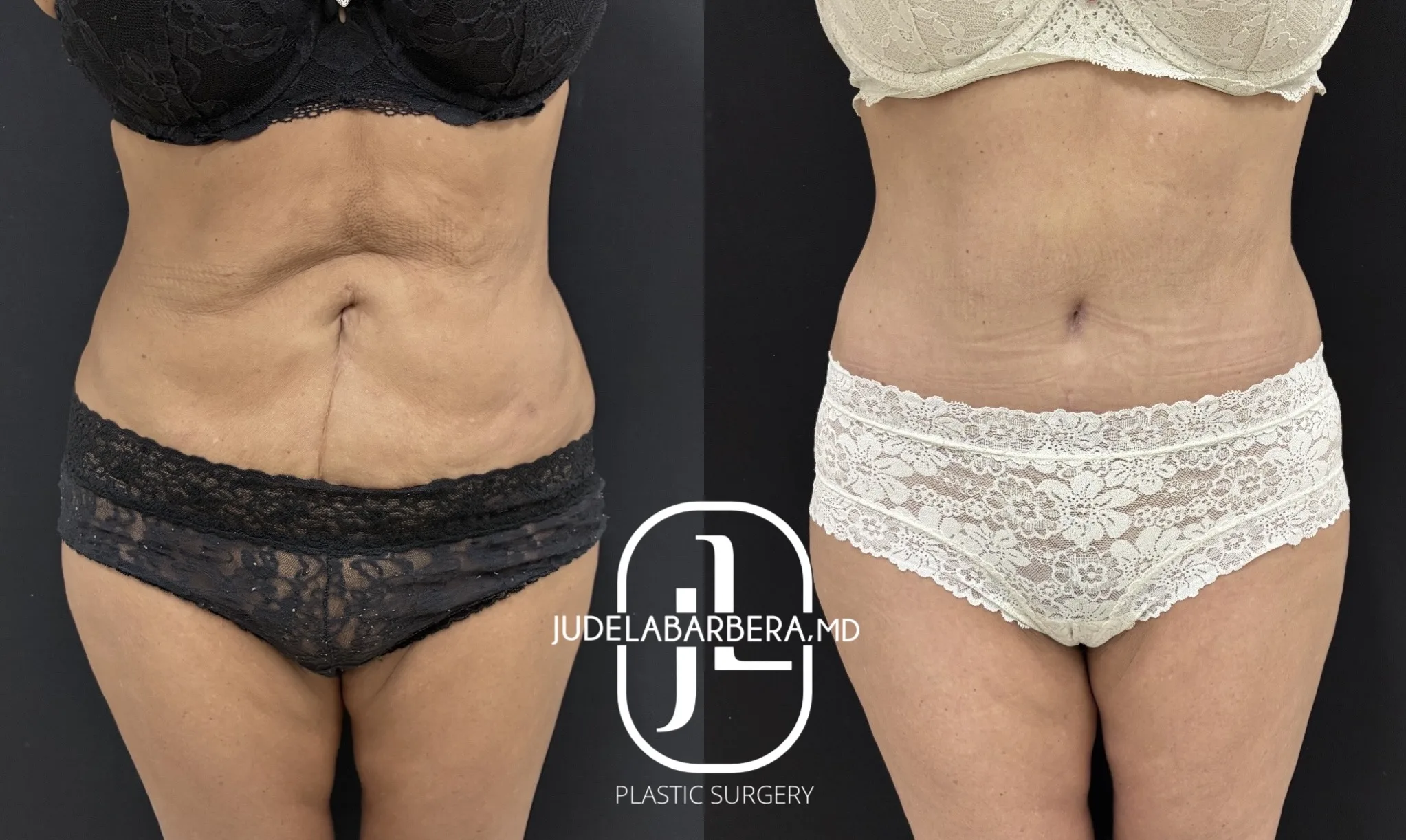 Before and after full frontal view of abdominal and thigh contouring results