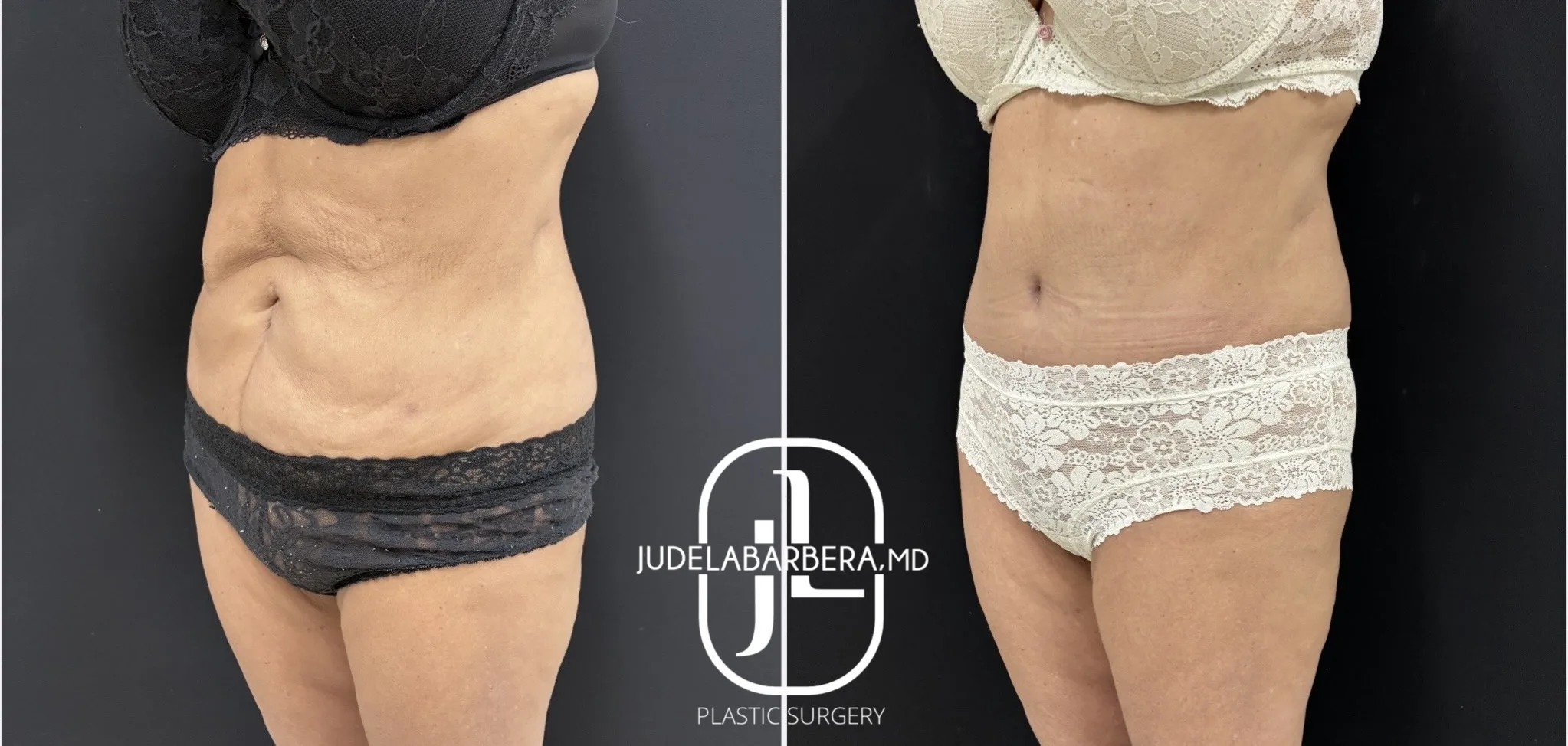 Before and after full body contouring showing front torso and thigh improvement