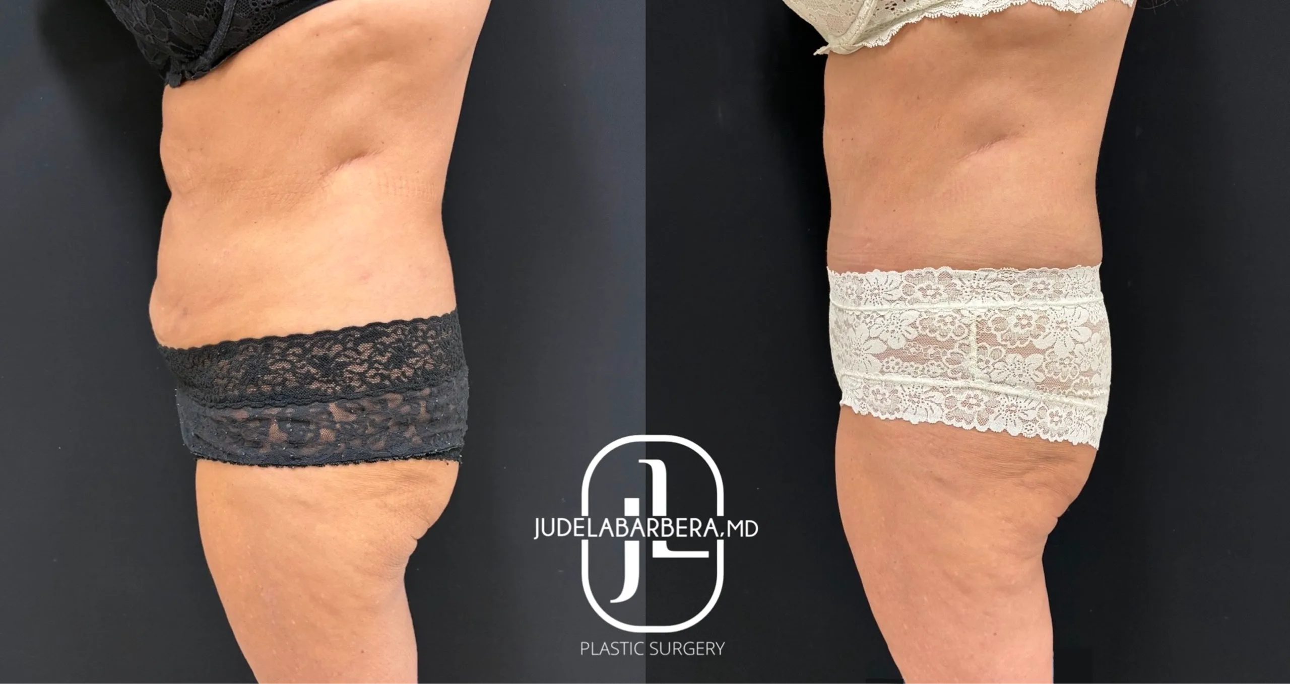 Before and after side view of torso and thigh contouring with reduced laxity