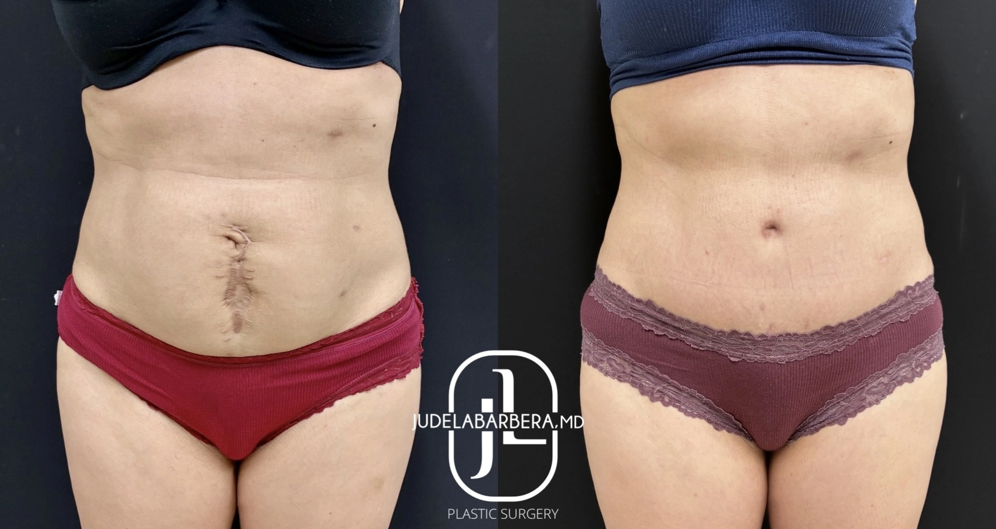 Before and after tummy tuck comparison showing front view with flattened abdomen and improved contour
