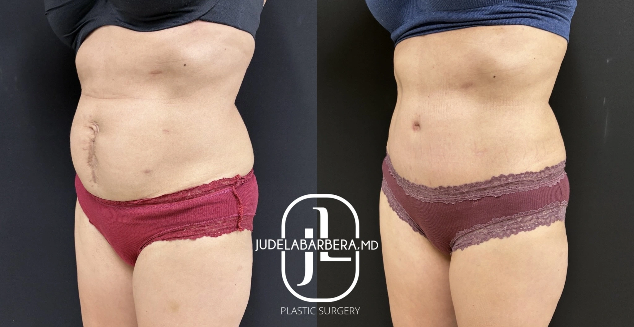 Before and after abdominoplasty results showing front torso view with reduced abdominal fullness