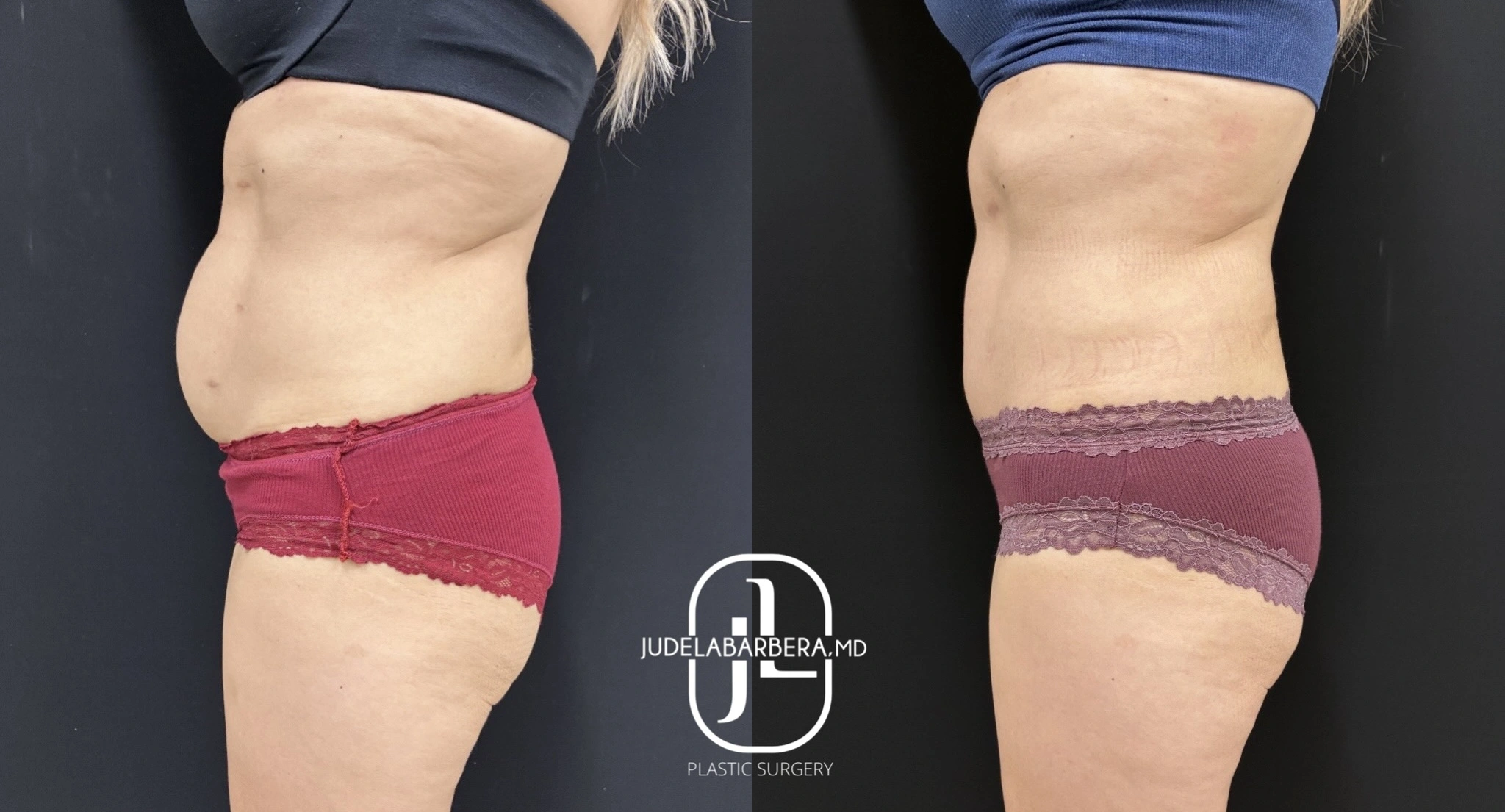 Before and after abdominal contouring results showing reduced midsection