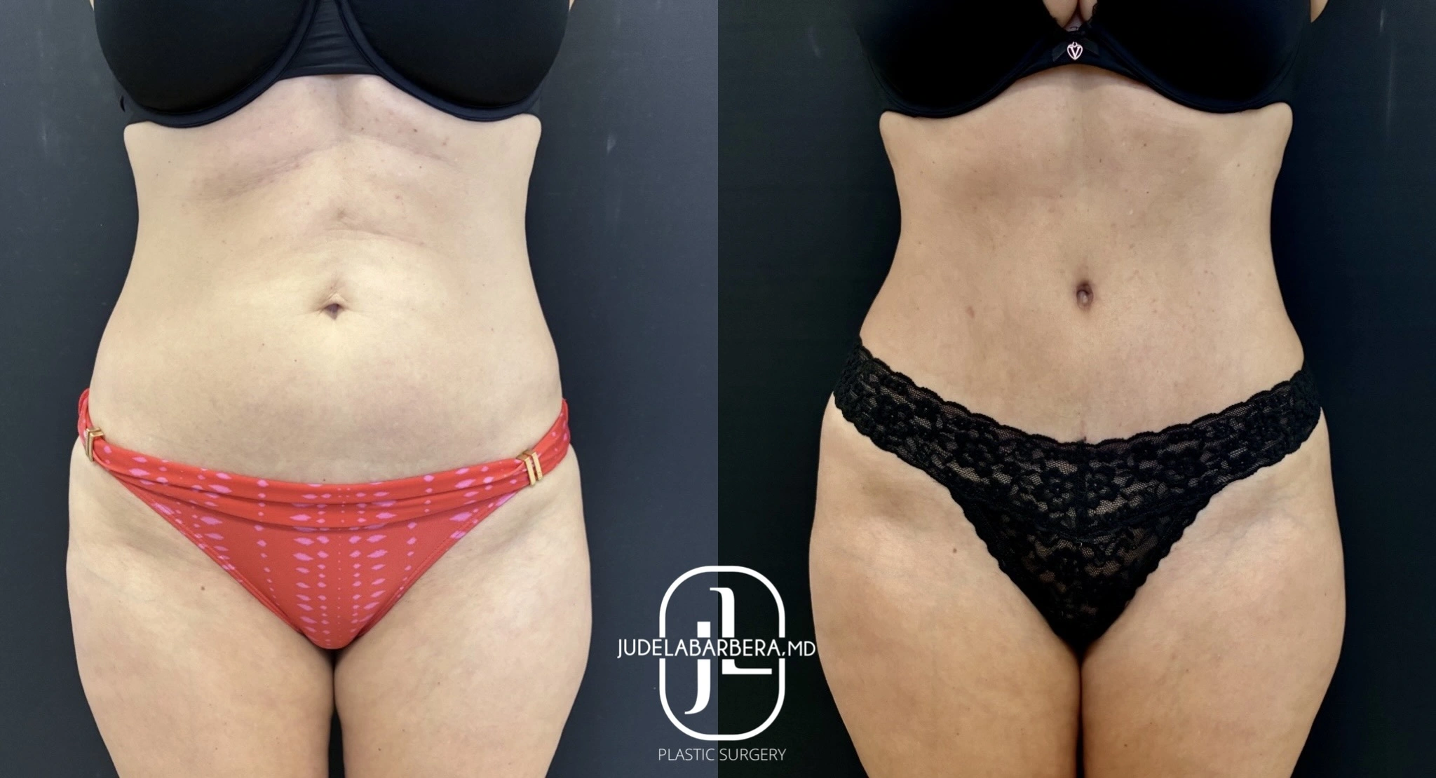 Before and after tummy tuck displaying front torso view with enhanced abdominal flatness and definition