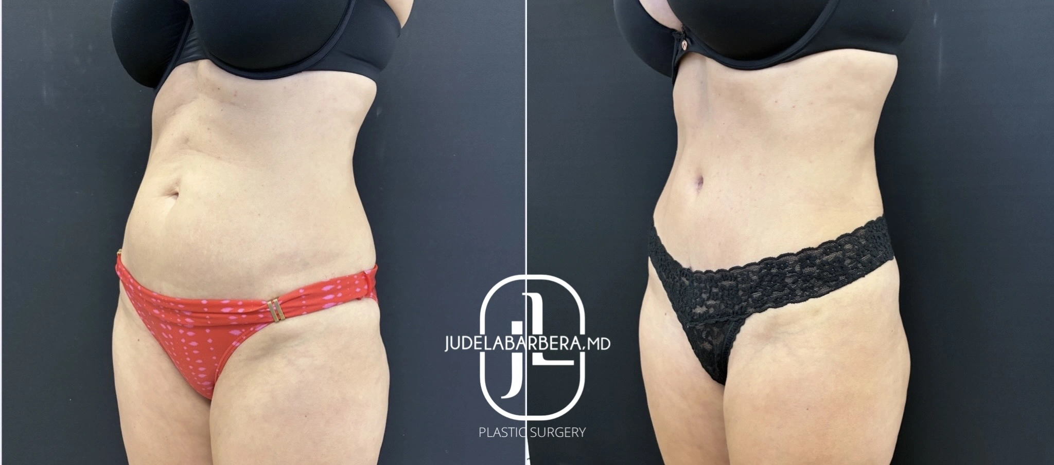 Before and after body contouring showing front view with improved abdominal and hip appearance