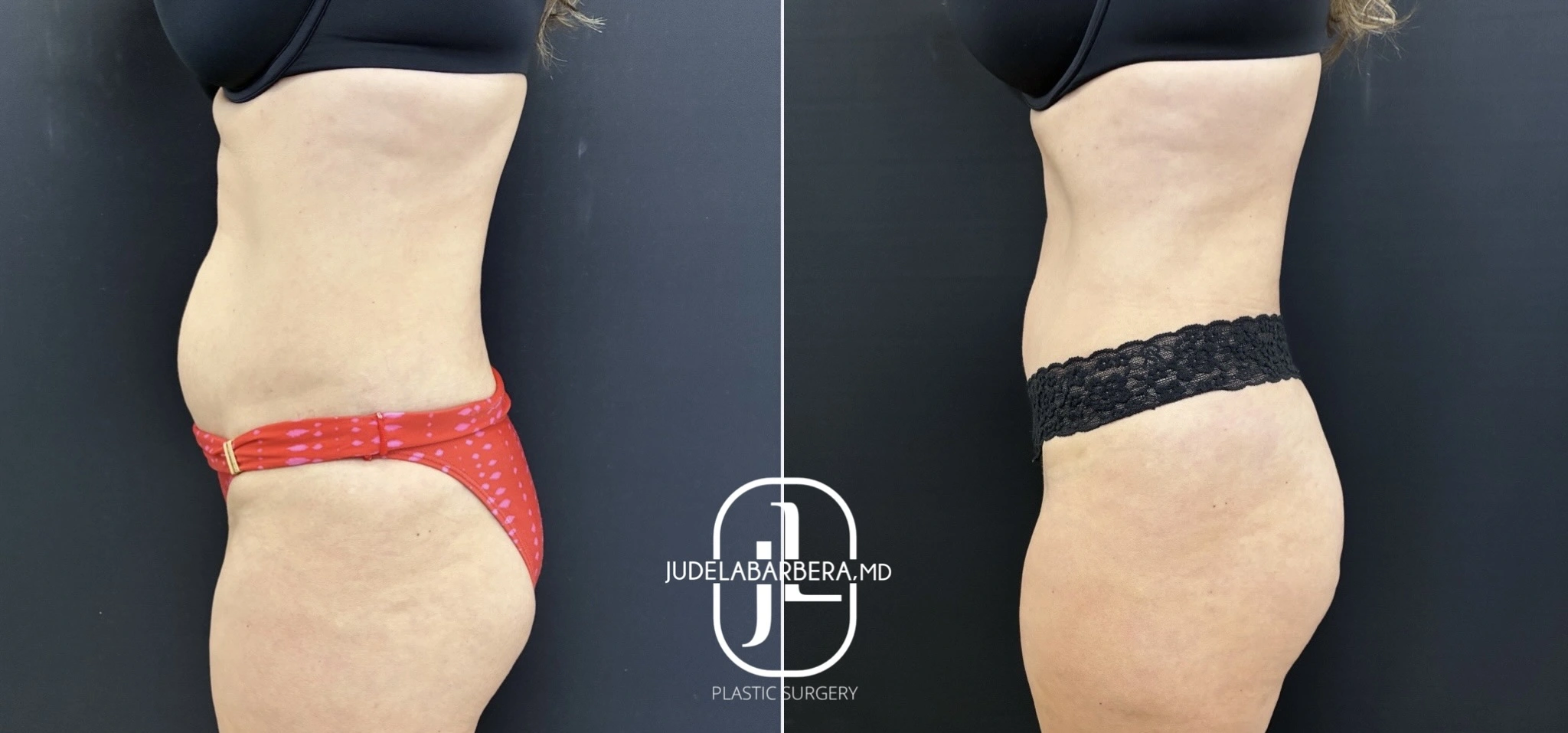 Before and after liposuction results showing side view with reduced waist and hip definition