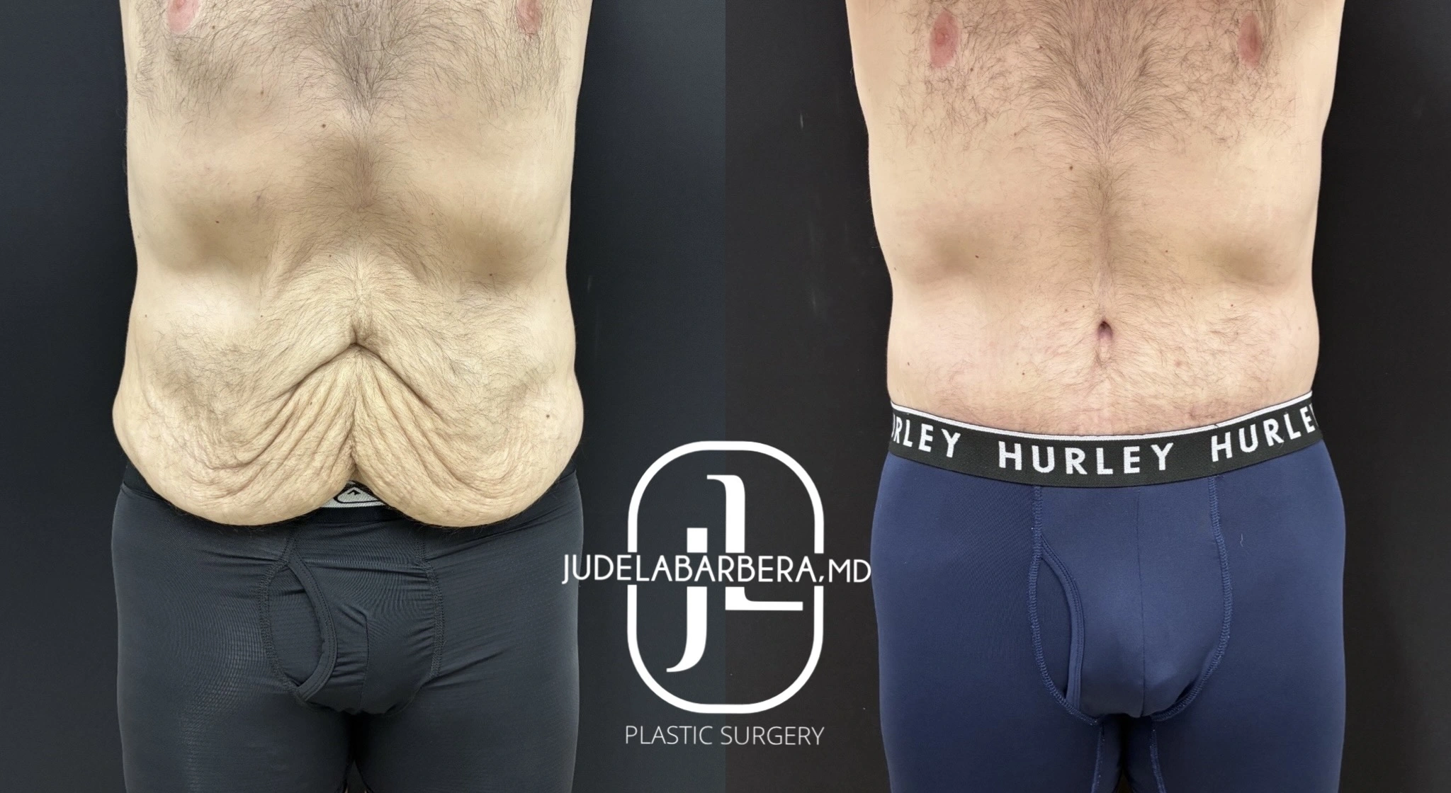Before and after abdominal contouring, frontal view showing reduced loose skin and muscle definition