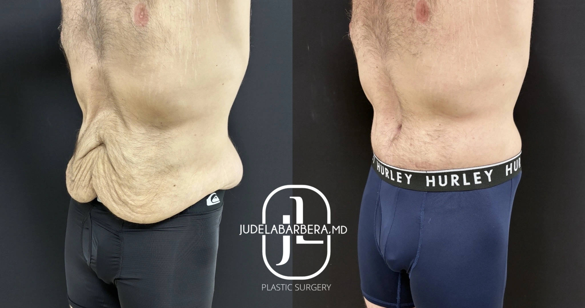 Before and after abdominal contouring, oblique view showing tightened midsection