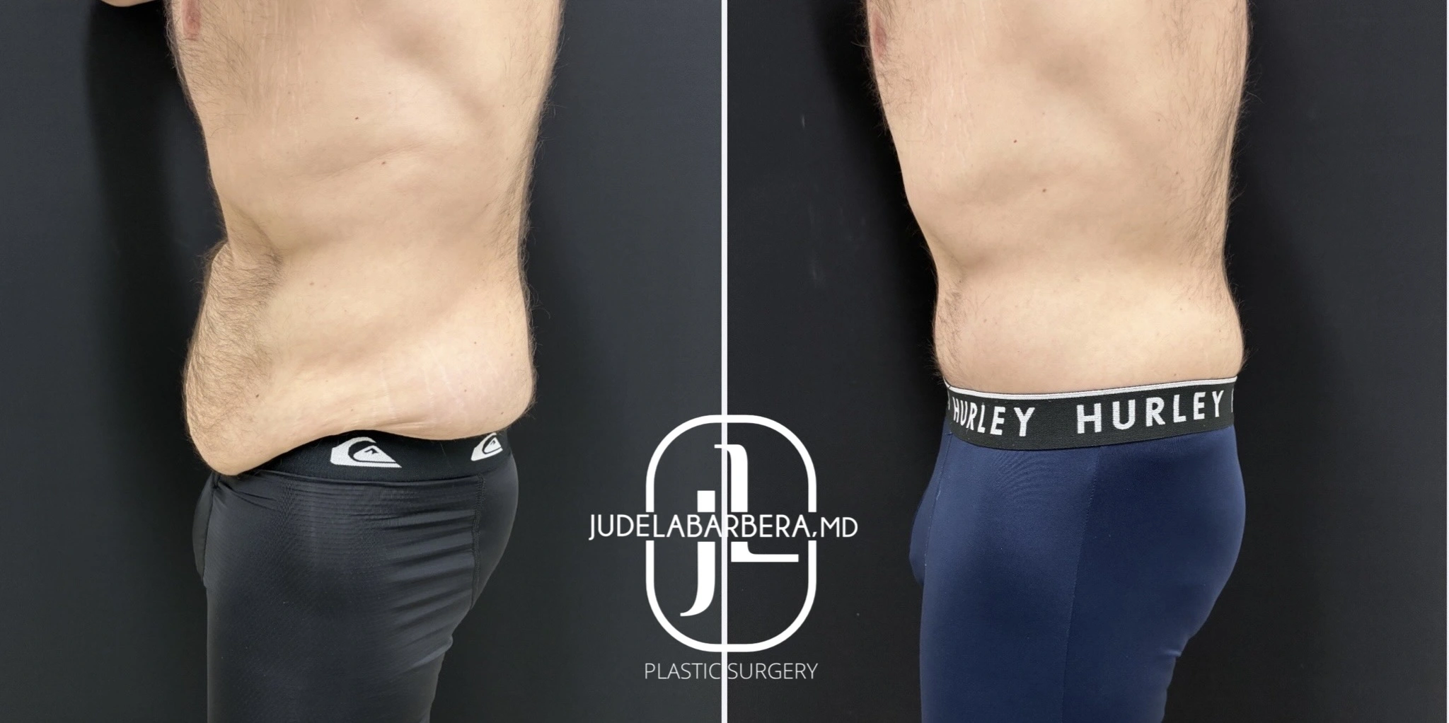 Before and after abdominal contouring, side view showing improved abdominal flatness
