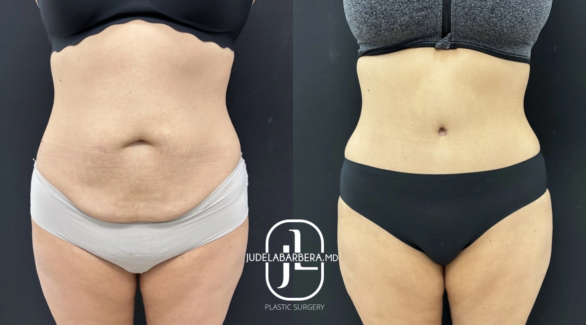 Before and after front view of lipoabdominoplasty showing diminished abdominal protrusion and defined waistline
