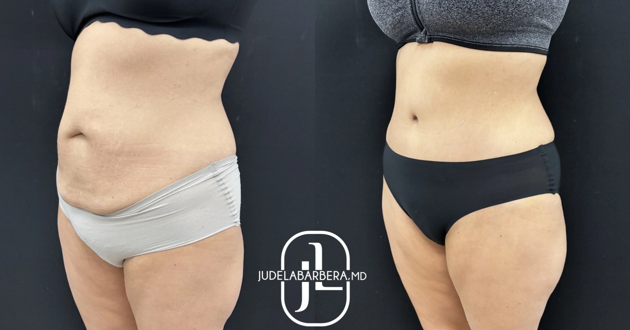 Before and after front view of abdominal liposuction showing reduced belly fullness and smoother midsection