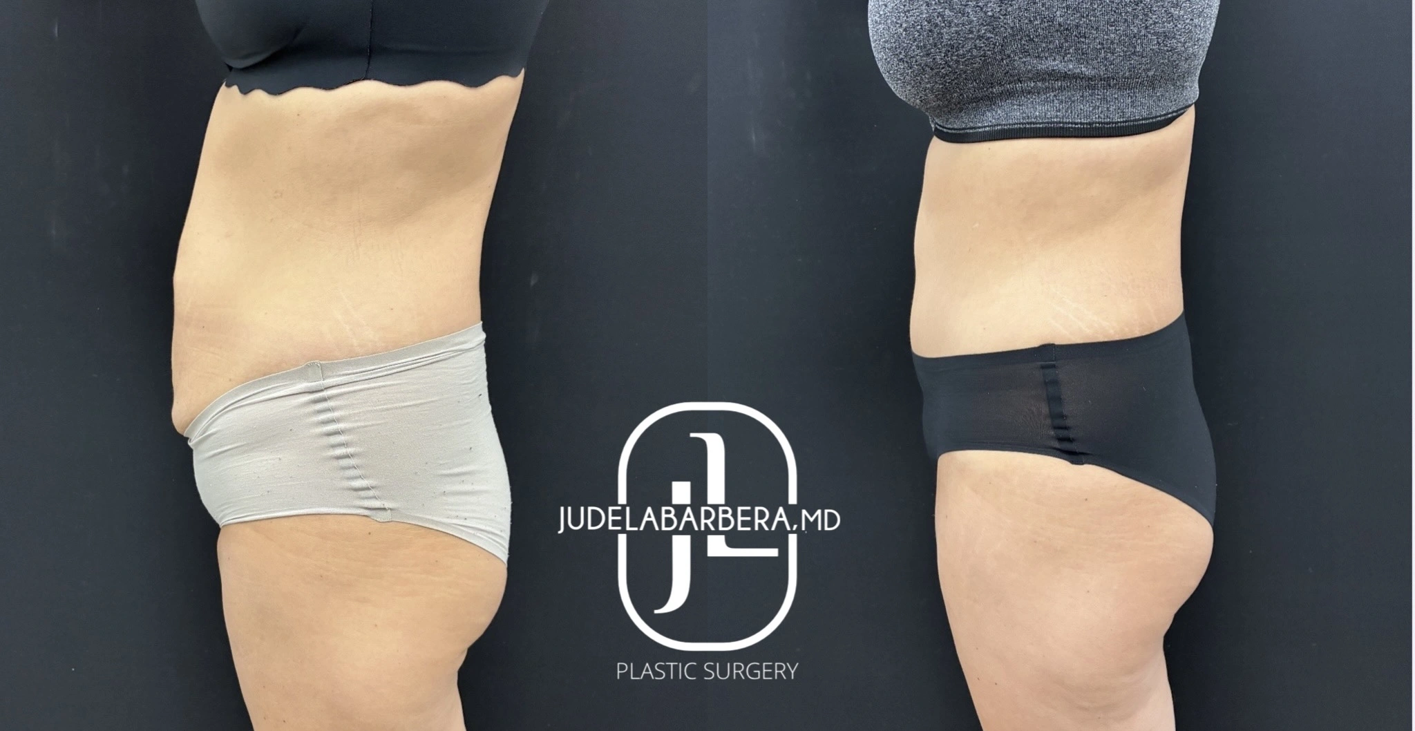 Before and after side view of abdominal contouring displaying reduced midsection bulk and refined silhouette