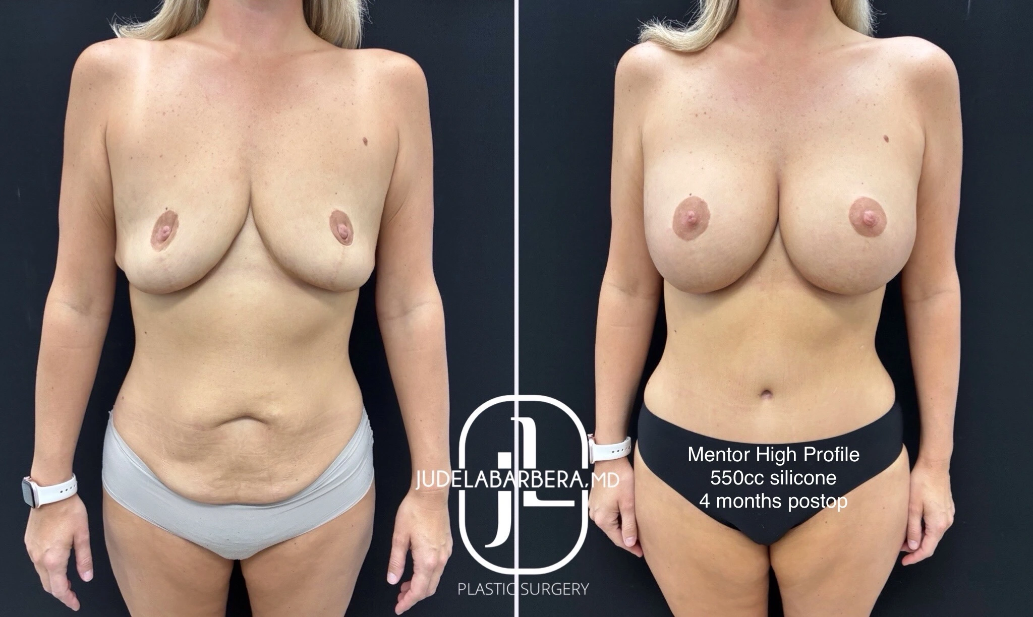 Before and after breast augmentation with Mentor High Profile 550cc silicone implants, 4 months post-op, front view