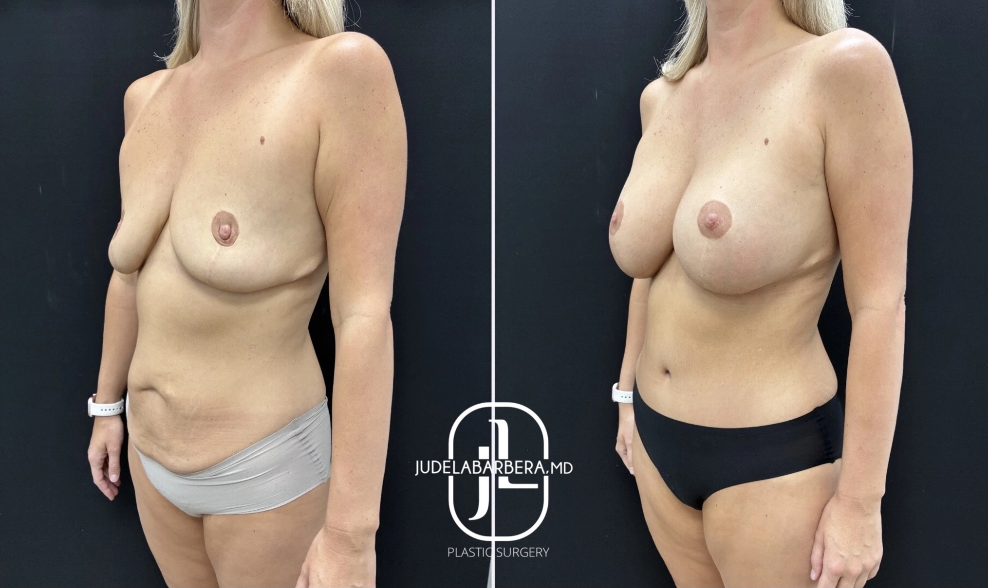 Before and after breast augmentation, oblique side view demonstrating enhanced shape and positioning