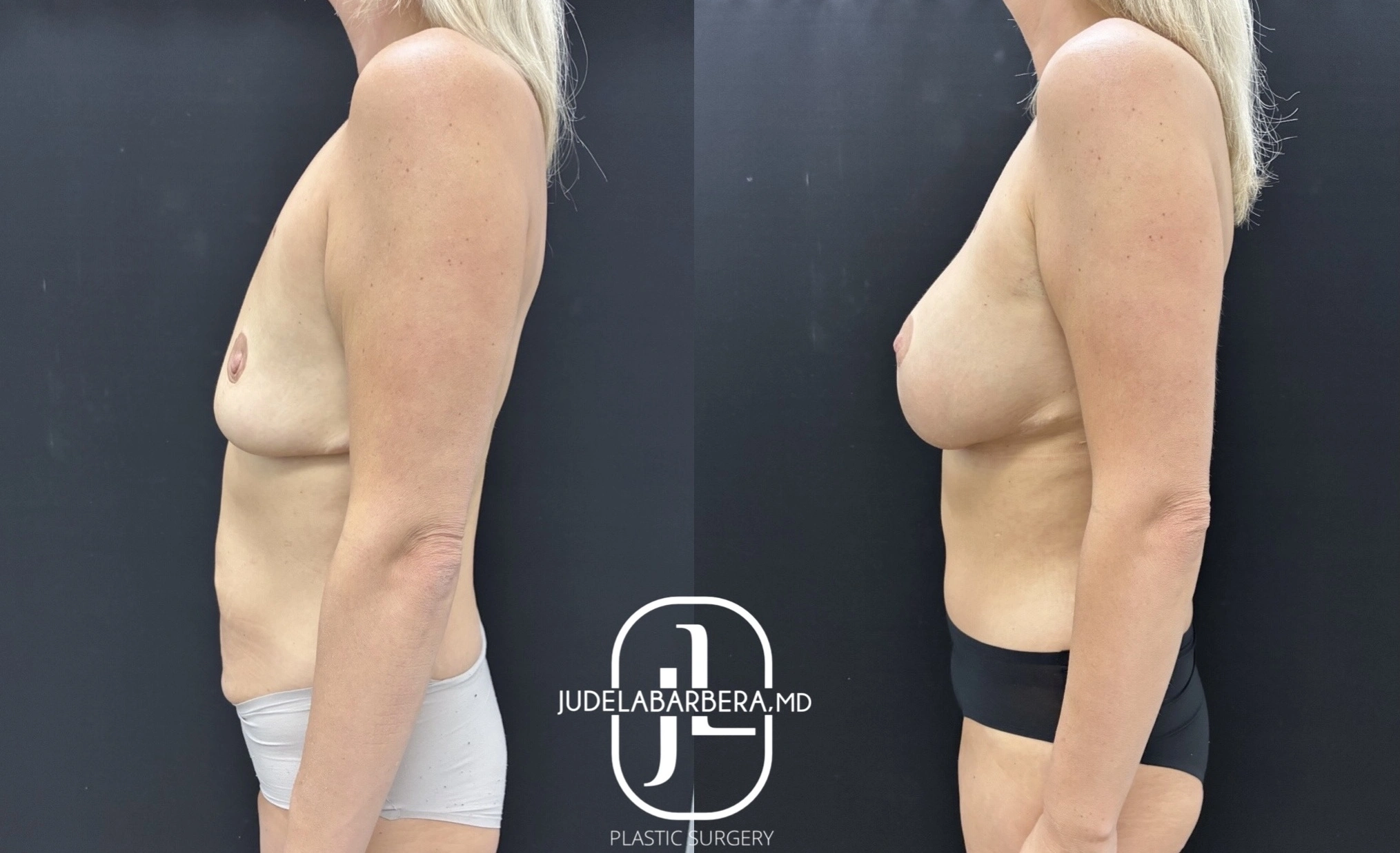 Before and after breast augmentation, side profile view showing improved projection and contour