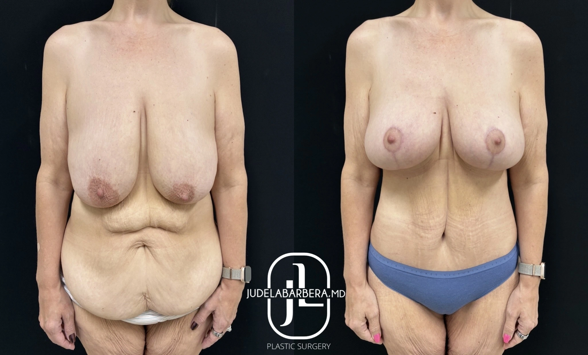 Before and after breast lift and augmentation, front view showing lifted contour and improved symmetry