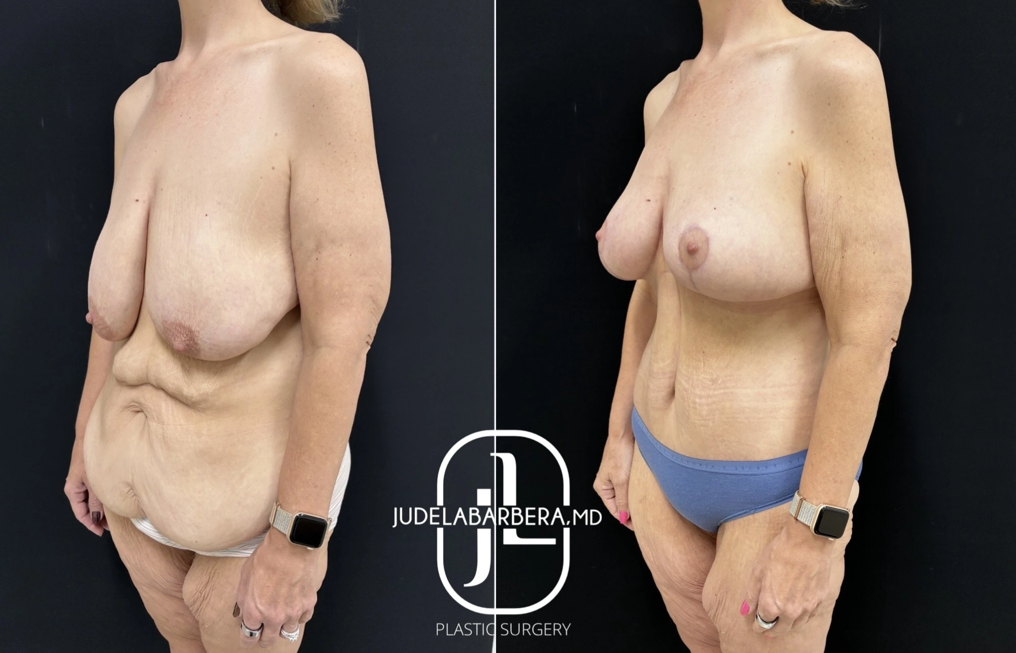 Before and after breast lift and augmentation, side profile view showing reduced sagging and improved projection