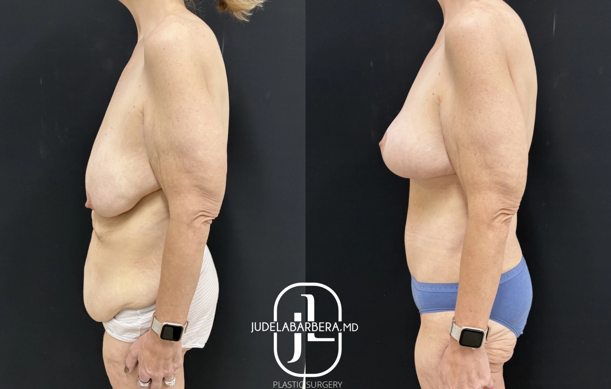 Before and after breast lift and augmentation, side profile view demonstrating elevated position and perkier appearance