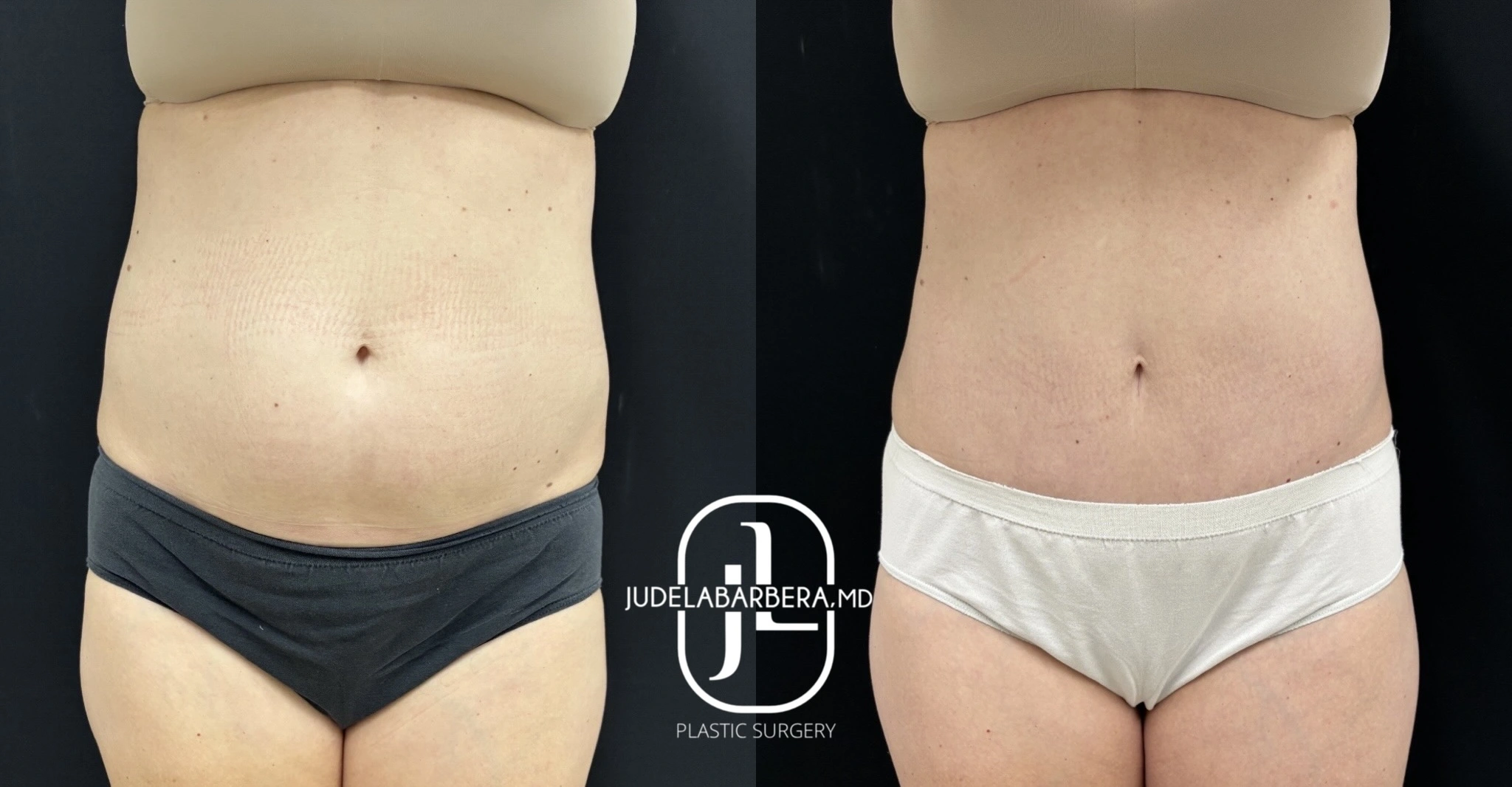 Before and after abdominal contouring, frontal view showing flatter abdominal profile