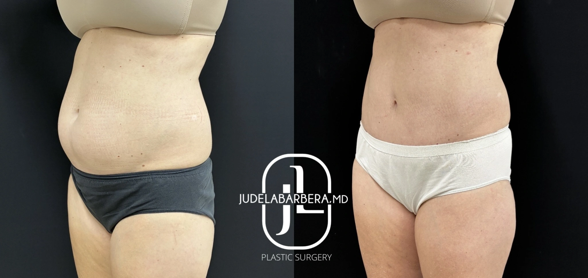 Before and after abdominal contouring, frontal view showing reduced midsection fullness